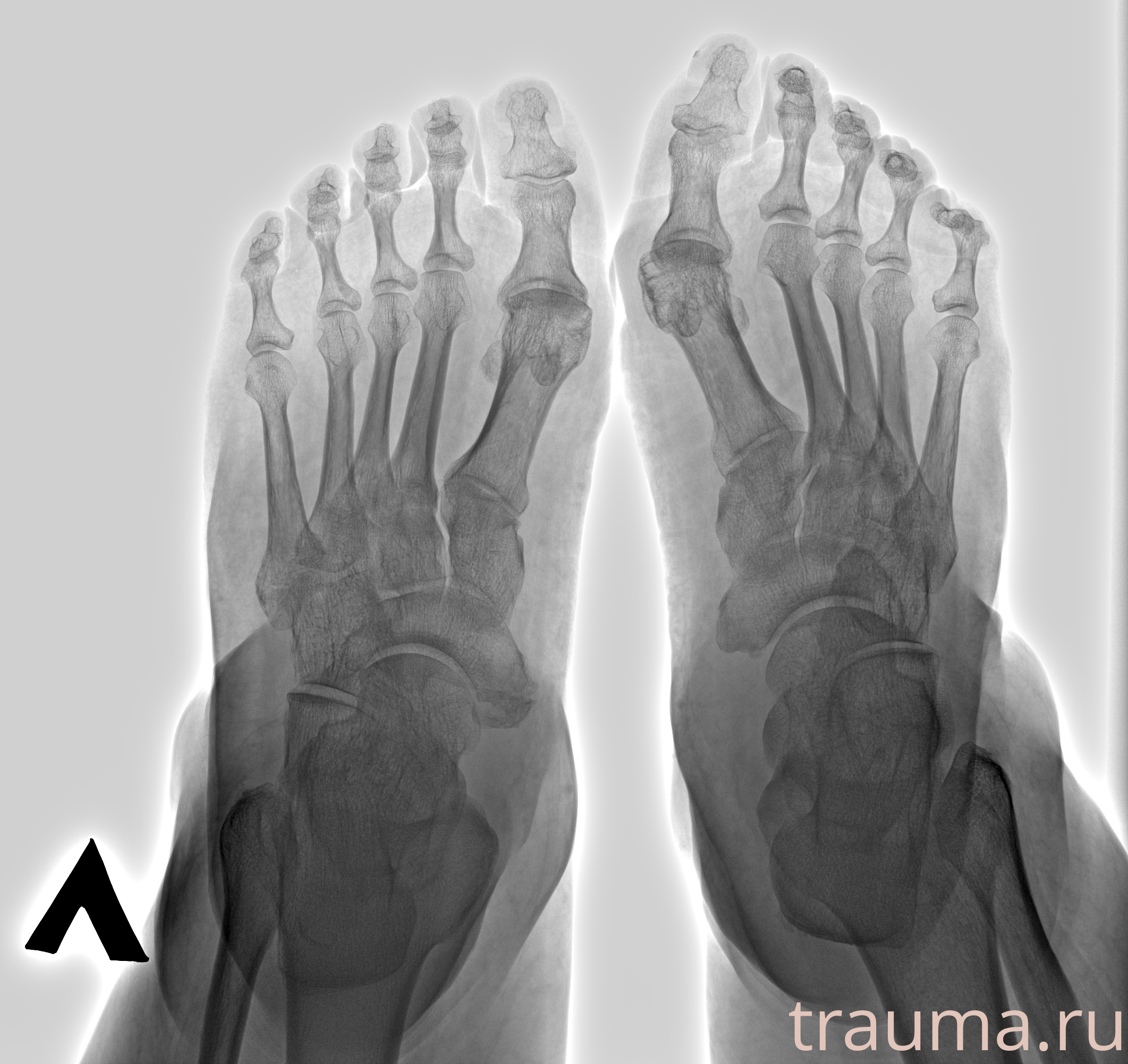 Рентген на дому: по вашему адресу приезжает врач-рентгенолог, травматолог-ортопед с мобильным рентгеновским аппаратом, проводит диагностику травмы или заболевания, делает необходимые рентгенограммы, дает рекомендации по дальнейшему лечению. Получить качественные снимки в домашних условиях возможно благодаря уникальной методике, разработанной МосРентген Центром для института  Склифосовского