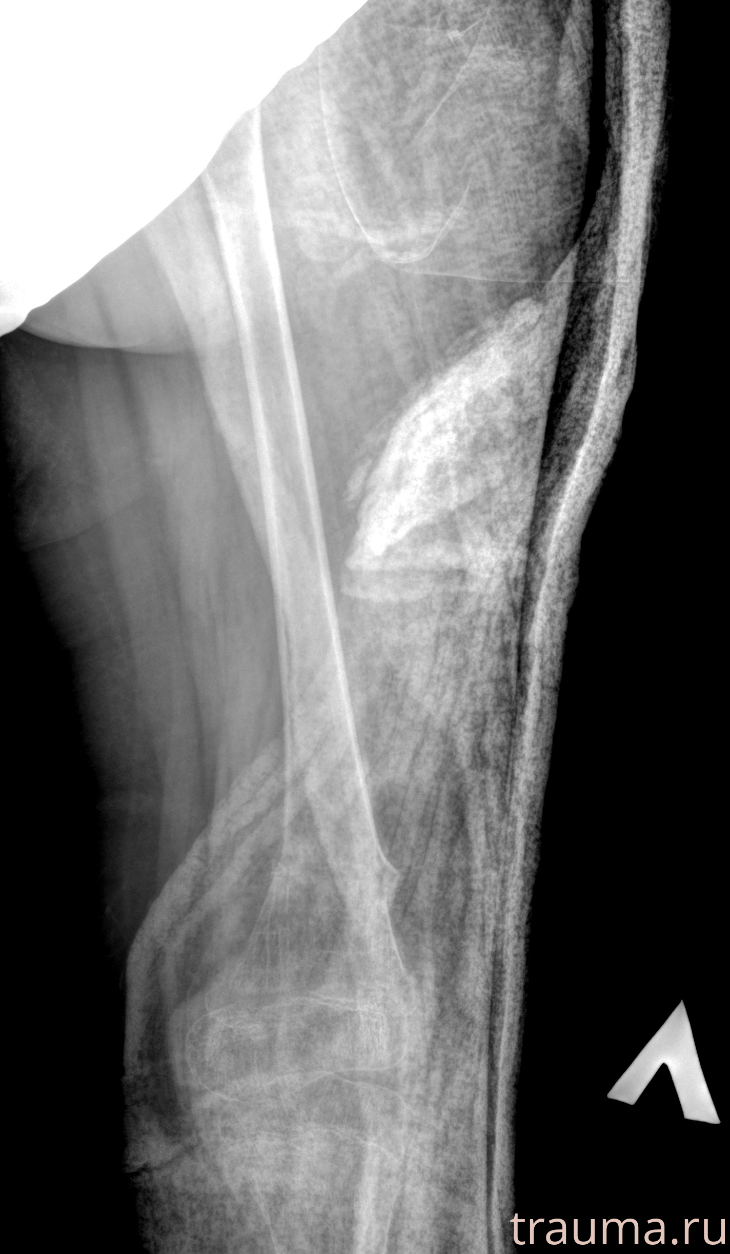 Рентген на дому: по вашему адресу приезжает врач-рентгенолог, травматолог-ортопед с мобильным рентгеновским аппаратом, проводит диагностику травмы или заболевания, делает необходимые рентгенограммы, дает рекомендации по дальнейшему лечению. Получить качественные снимки в домашних условиях возможно благодаря уникальной методике, разработанной МосРентген Центром для института  Склифосовского