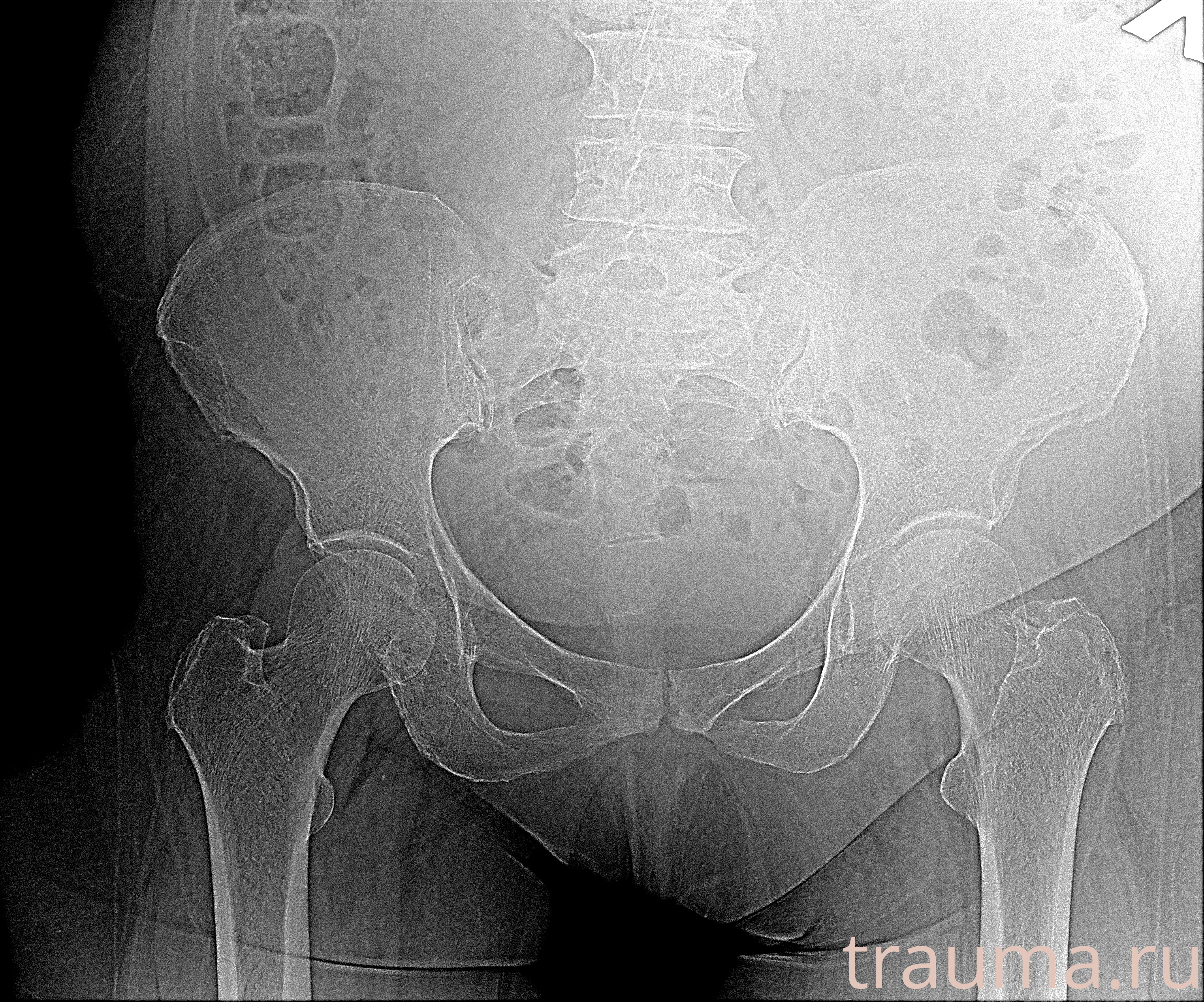 Рентген на дому: по вашему адресу приезжает врач-рентгенолог, травматолог-ортопед с мобильным рентгеновским аппаратом, проводит диагностику травмы или заболевания, делает необходимые рентгенограммы, дает рекомендации по дальнейшему лечению. Получить качественные снимки в домашних условиях возможно благодаря уникальной методике, разработанной МосРентген Центром для института  Склифосовского