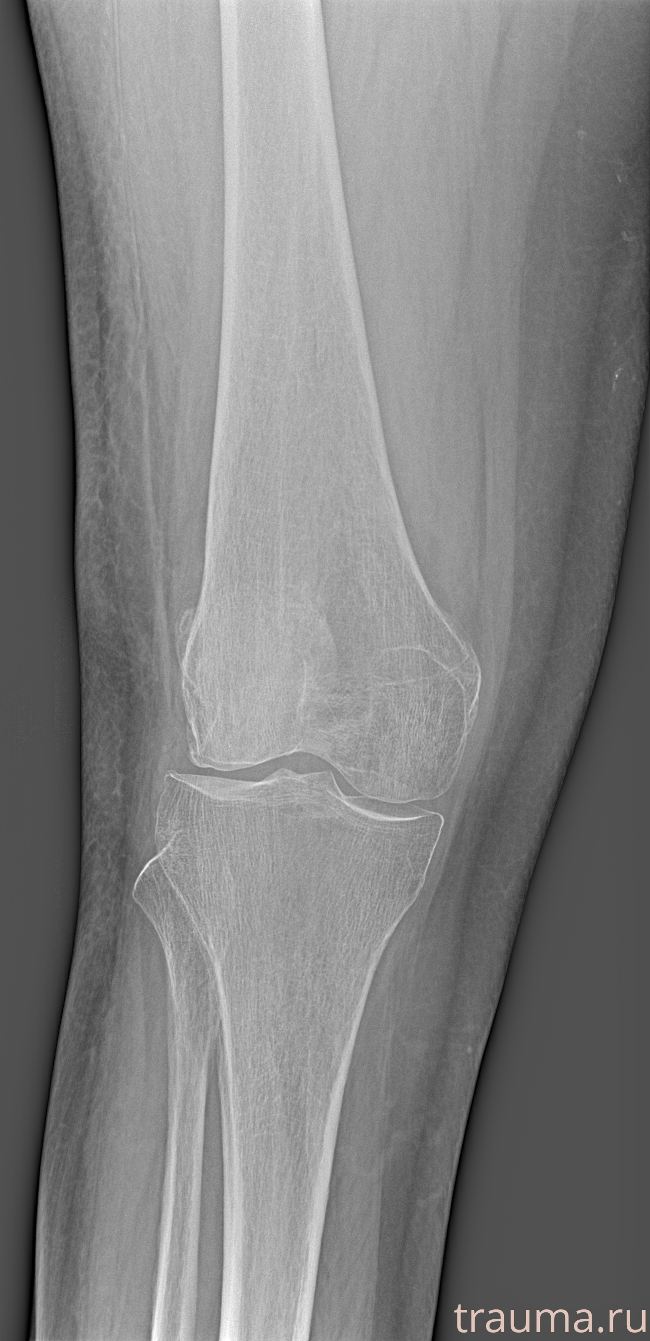 Рентген на дому: по вашему адресу приезжает врач-рентгенолог, травматолог-ортопед с мобильным рентгеновским аппаратом, проводит диагностику травмы или заболевания, делает необходимые рентгенограммы, дает рекомендации по дальнейшему лечению. Получить качественные снимки в домашних условиях возможно благодаря уникальной методике, разработанной МосРентген Центром для института  Склифосовского