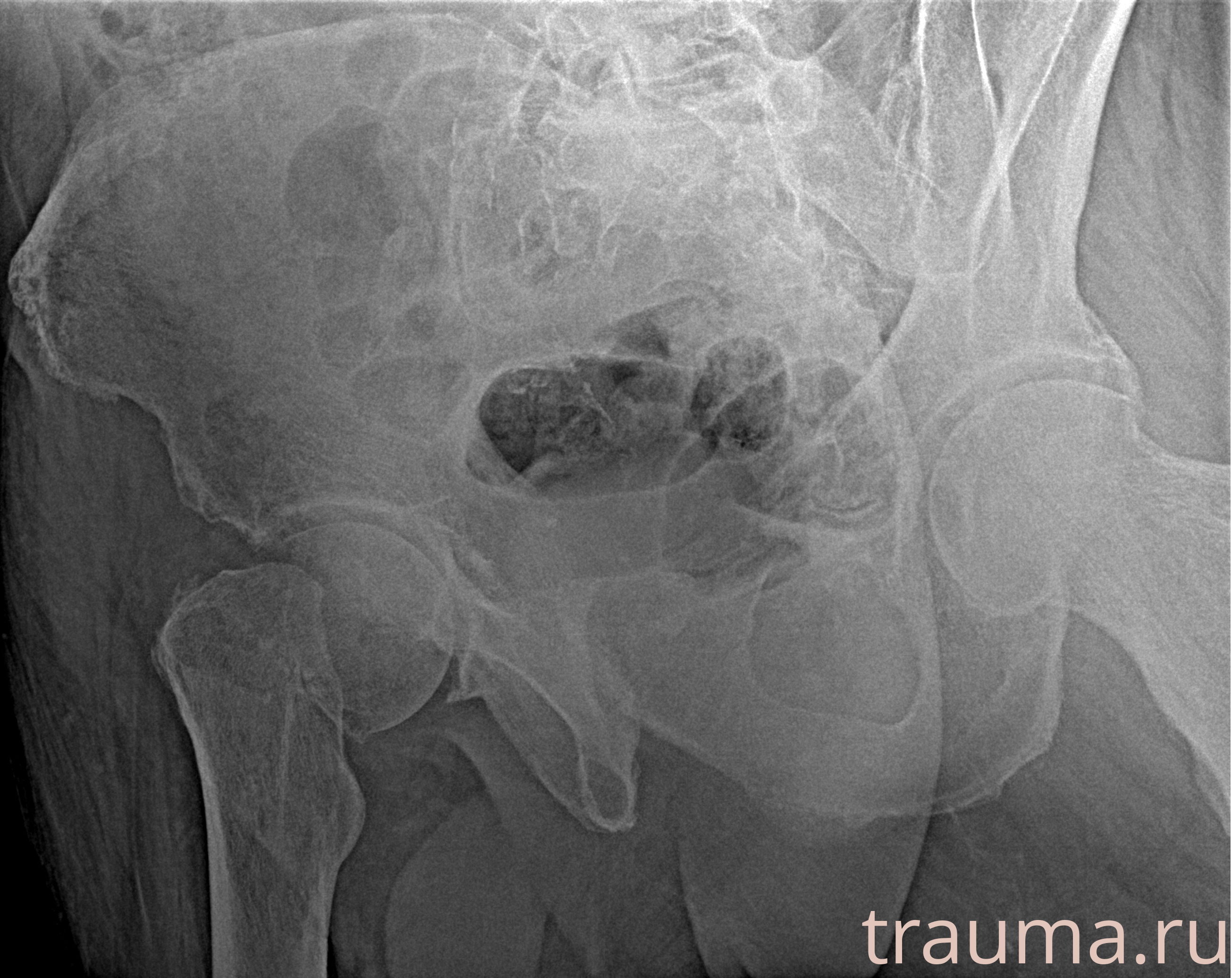 Рентген на дому: по вашему адресу приезжает врач-рентгенолог, травматолог-ортопед с мобильным рентгеновским аппаратом, проводит диагностику травмы или заболевания, делает необходимые рентгенограммы, дает рекомендации по дальнейшему лечению. Получить качественные снимки в домашних условиях возможно благодаря уникальной методике, разработанной МосРентген Центром для института  Склифосовского