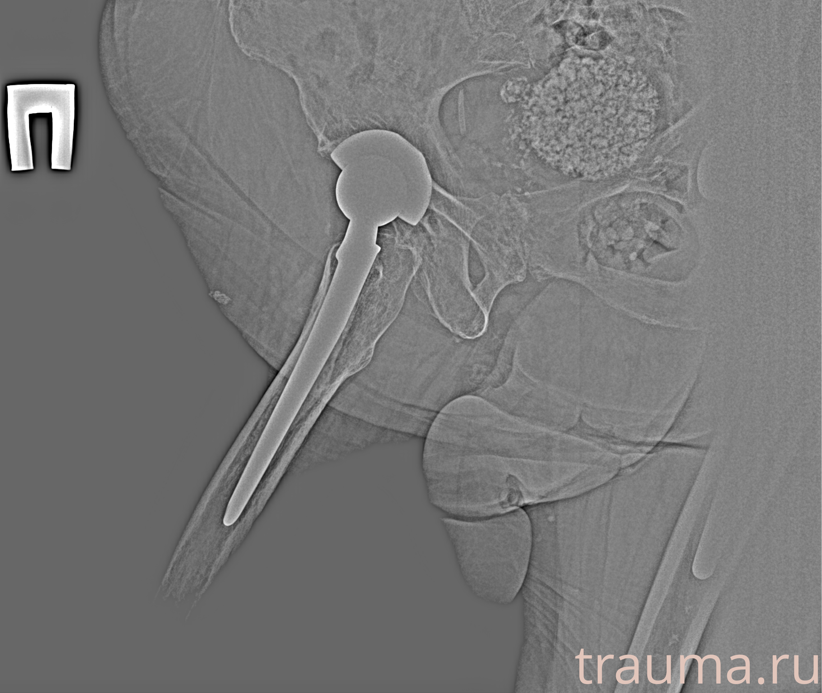 Рентген на дому: по вашему адресу приезжает врач-рентгенолог, травматолог-ортопед с мобильным рентгеновским аппаратом, проводит диагностику травмы или заболевания, делает необходимые рентгенограммы, дает рекомендации по дальнейшему лечению. Получить качественные снимки в домашних условиях возможно благодаря уникальной методике, разработанной МосРентген Центром для института  Склифосовского