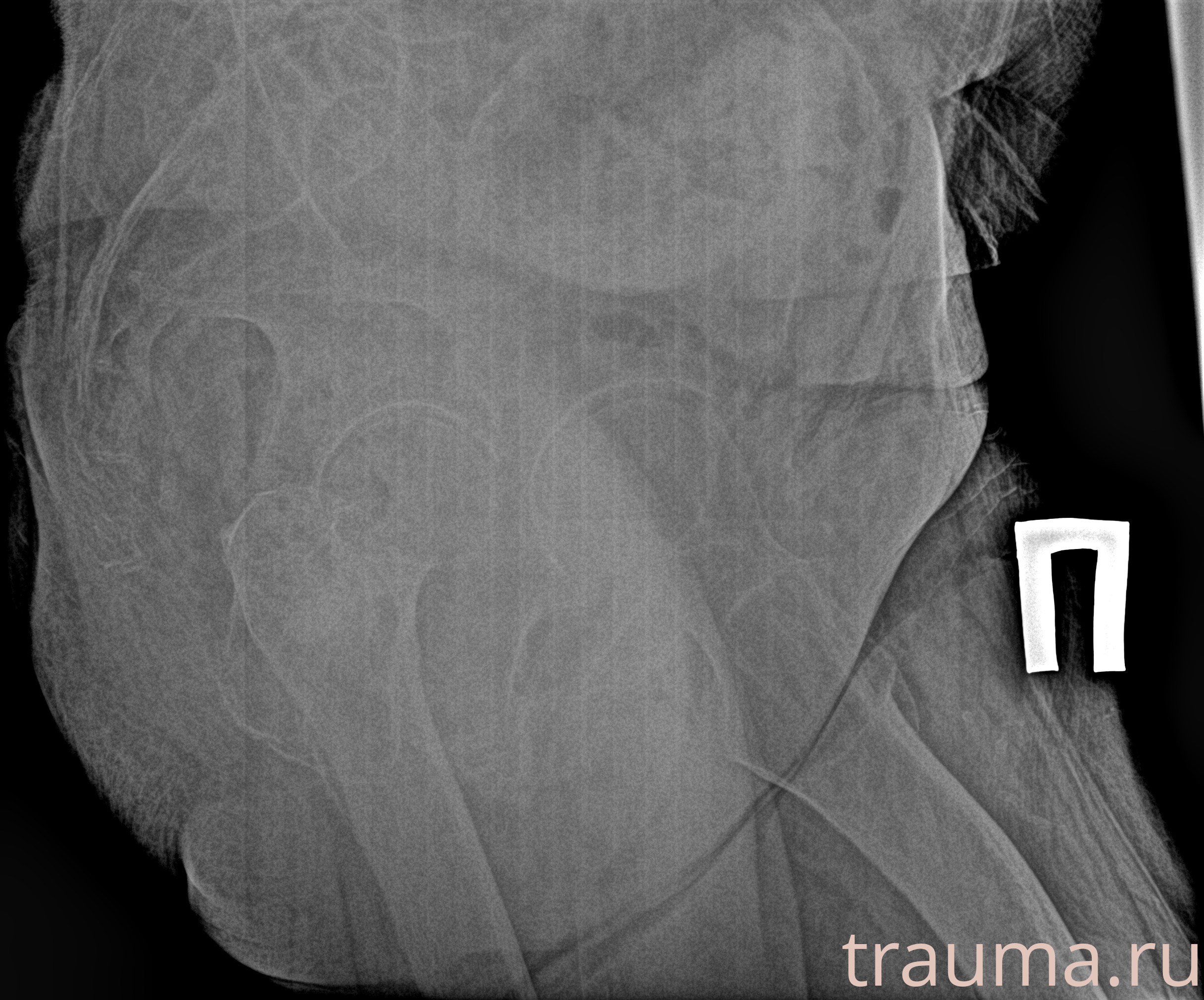 Рентген на дому: по вашему адресу приезжает врач-рентгенолог, травматолог-ортопед с мобильным рентгеновским аппаратом, проводит диагностику травмы или заболевания, делает необходимые рентгенограммы, дает рекомендации по дальнейшему лечению. Получить качественные снимки в домашних условиях возможно благодаря уникальной методике, разработанной МосРентген Центром для института  Склифосовского