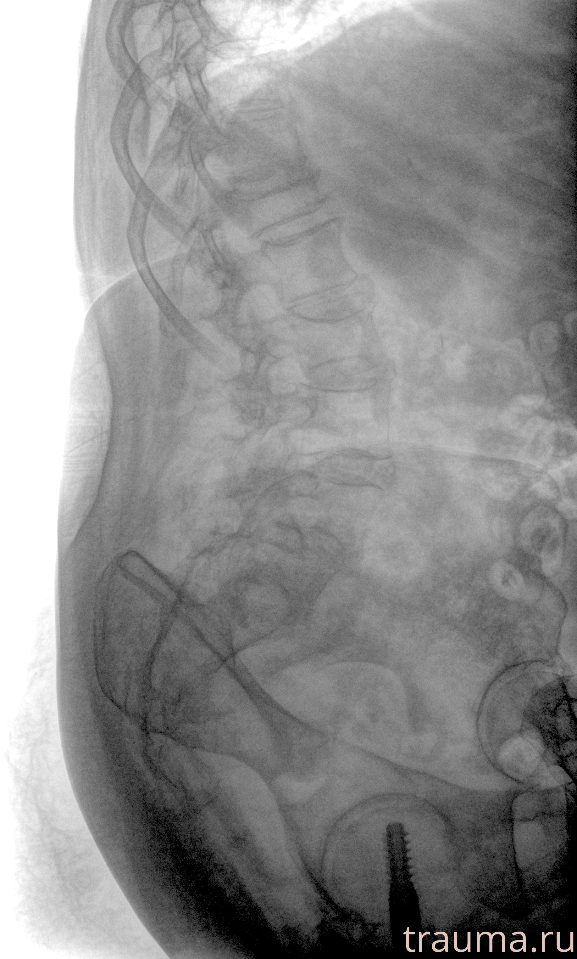 Рентген на дому: по вашему адресу приезжает врач-рентгенолог, травматолог-ортопед с мобильным рентгеновским аппаратом, проводит диагностику травмы или заболевания, делает необходимые рентгенограммы, дает рекомендации по дальнейшему лечению. Получить качественные снимки в домашних условиях возможно благодаря уникальной методике, разработанной МосРентген Центром для института  Склифосовского