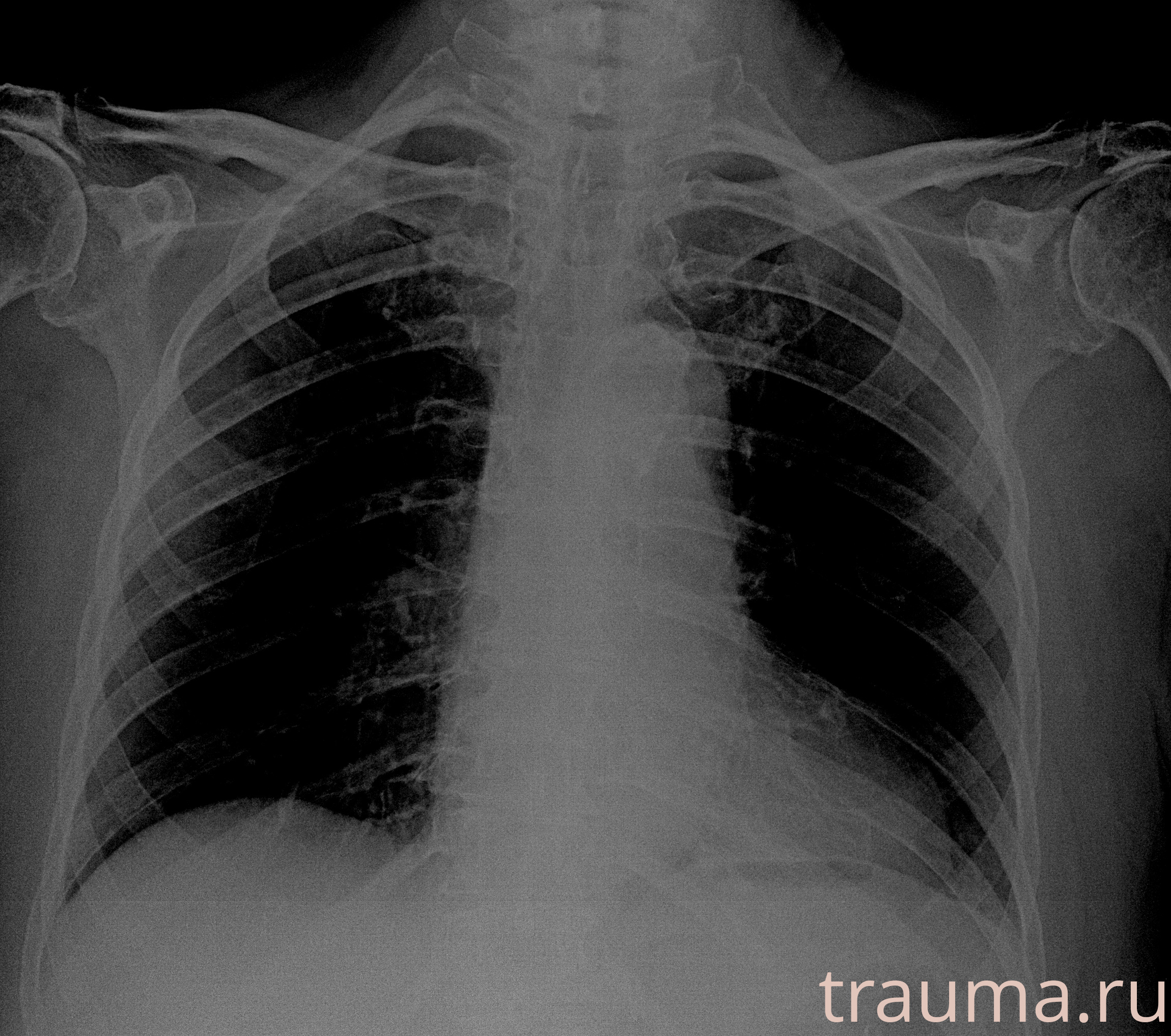Рентген на дому: по вашему адресу приезжает врач-рентгенолог, травматолог-ортопед с мобильным рентгеновским аппаратом, проводит диагностику травмы или заболевания, делает необходимые рентгенограммы, дает рекомендации по дальнейшему лечению. Получить качественные снимки в домашних условиях возможно благодаря уникальной методике, разработанной МосРентген Центром для института  Склифосовского