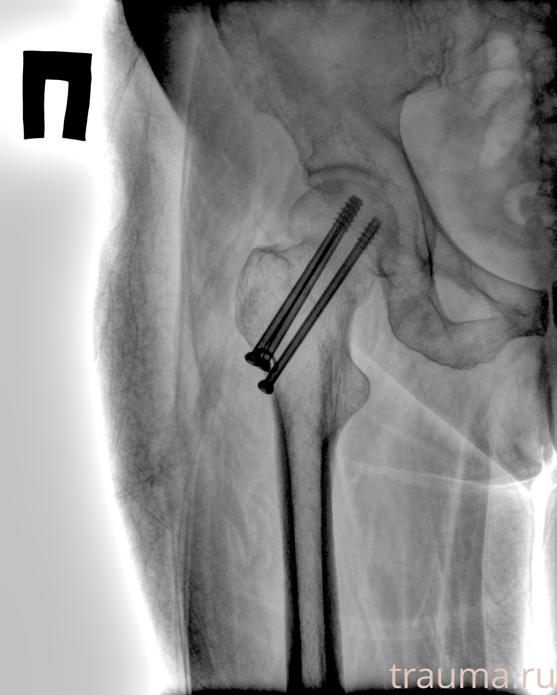 Рентген на дому: по вашему адресу приезжает врач-рентгенолог, травматолог-ортопед с мобильным рентгеновским аппаратом, проводит диагностику травмы или заболевания, делает необходимые рентгенограммы, дает рекомендации по дальнейшему лечению. Получить качественные снимки в домашних условиях возможно благодаря уникальной методике, разработанной МосРентген Центром для института  Склифосовского