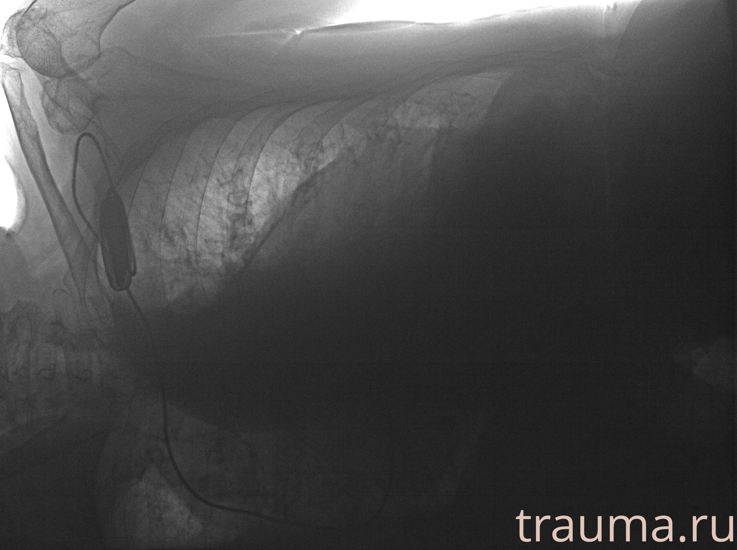 Рентген на дому: по вашему адресу приезжает врач-рентгенолог, травматолог-ортопед с мобильным рентгеновским аппаратом, проводит диагностику травмы или заболевания, делает необходимые рентгенограммы, дает рекомендации по дальнейшему лечению. Получить качественные снимки в домашних условиях возможно благодаря уникальной методике, разработанной МосРентген Центром для института  Склифосовского