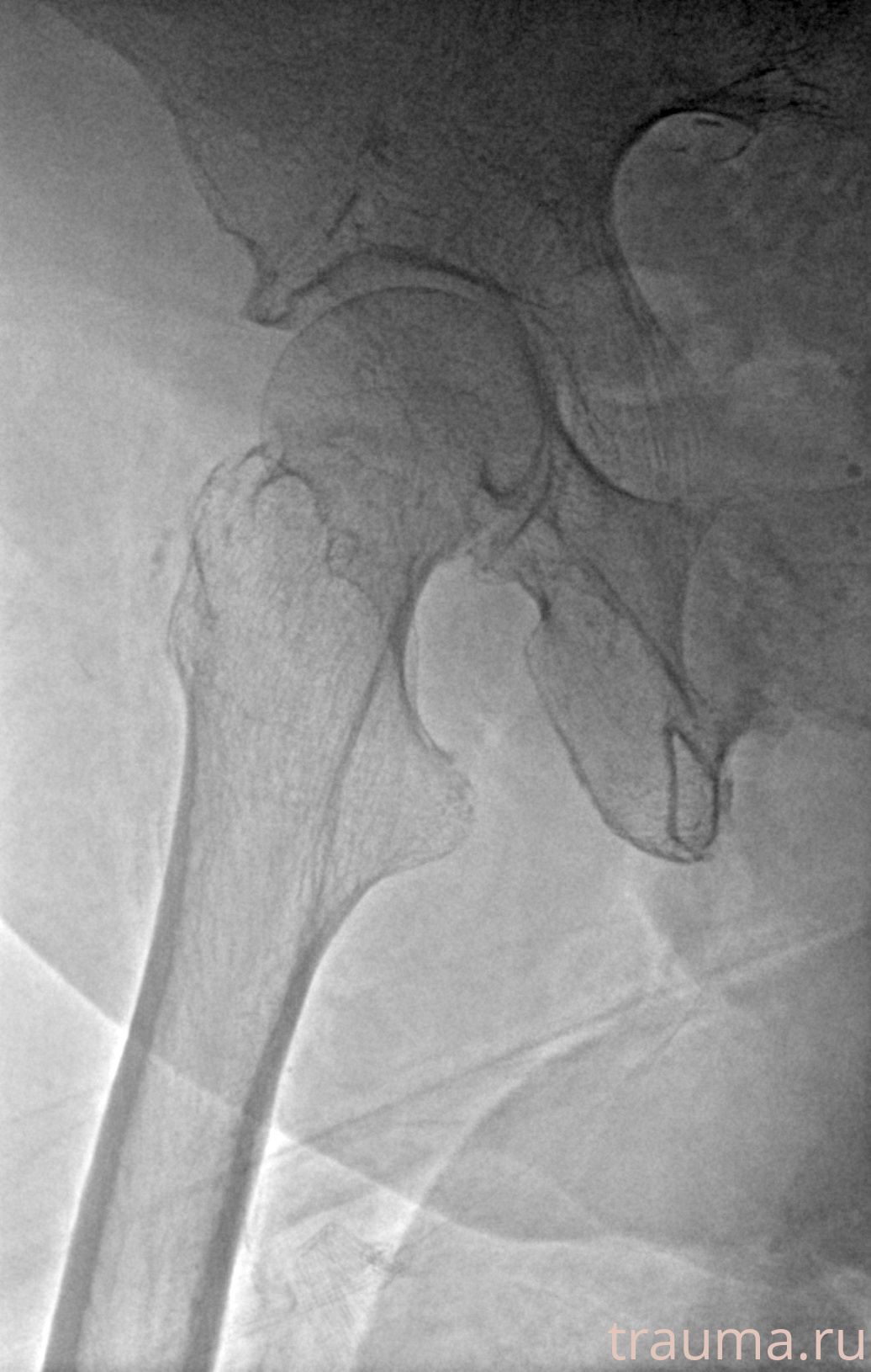 Рентген на дому: по вашему адресу приезжает врач-рентгенолог, травматолог-ортопед с мобильным рентгеновским аппаратом, проводит диагностику травмы или заболевания, делает необходимые рентгенограммы, дает рекомендации по дальнейшему лечению. Получить качественные снимки в домашних условиях возможно благодаря уникальной методике, разработанной МосРентген Центром для института  Склифосовского