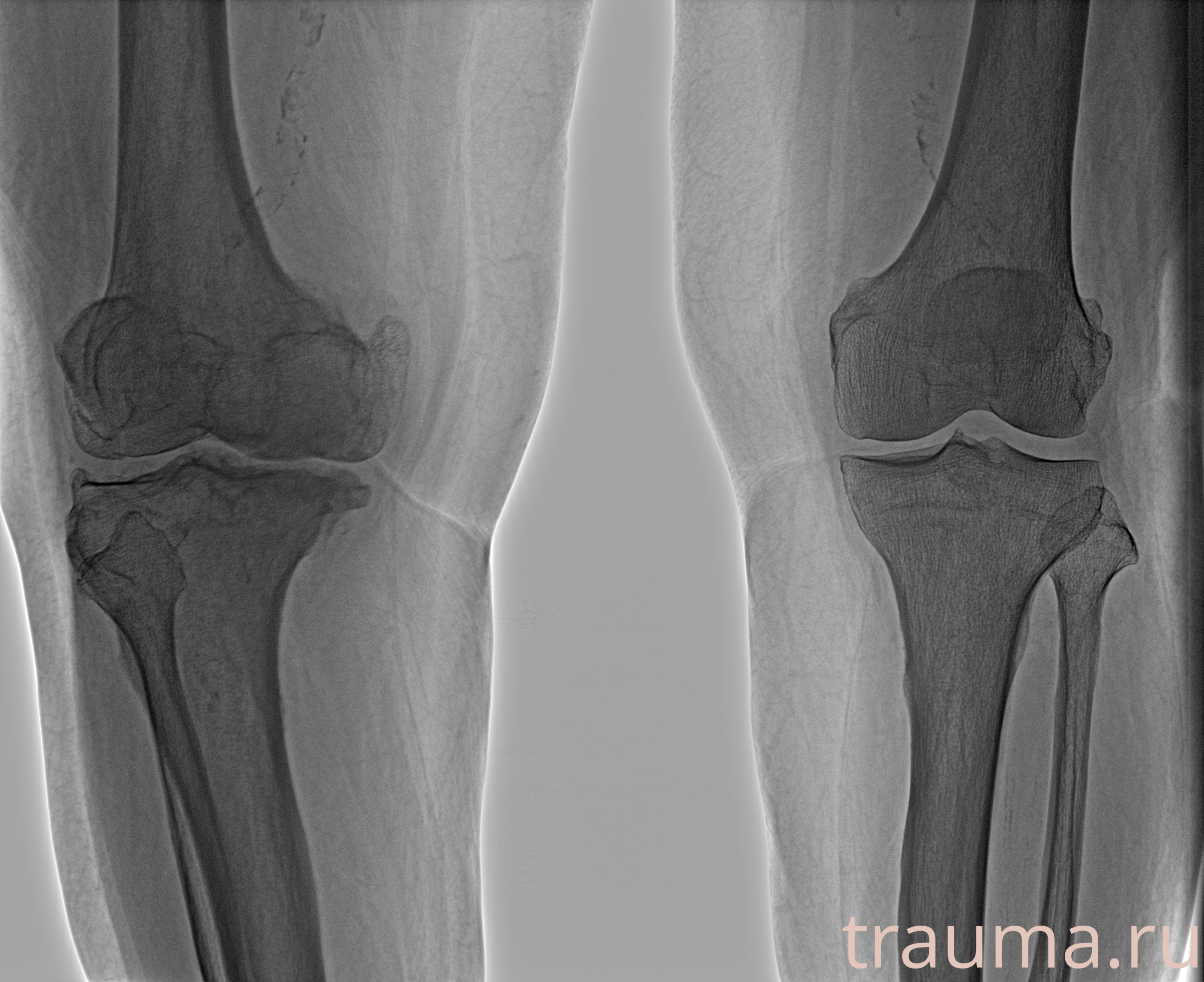 Рентген на дому: по вашему адресу приезжает врач-рентгенолог, травматолог-ортопед с мобильным рентгеновским аппаратом, проводит диагностику травмы или заболевания, делает необходимые рентгенограммы, дает рекомендации по дальнейшему лечению. Получить качественные снимки в домашних условиях возможно благодаря уникальной методике, разработанной МосРентген Центром для института  Склифосовского