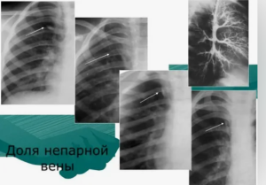 Щель непарной вены (добавочная)