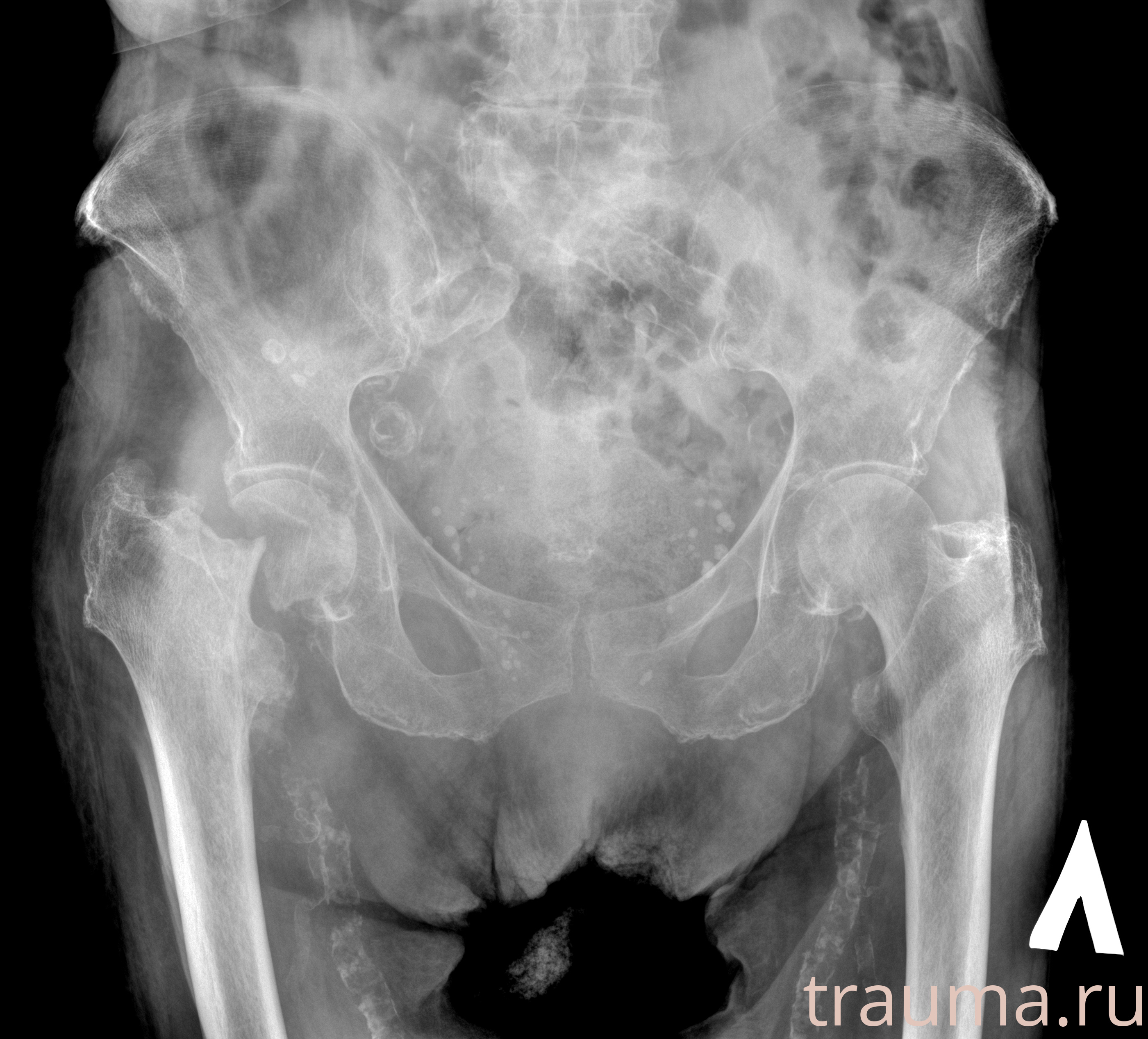 Рентген на дому: по вашему адресу приезжает врач-рентгенолог, травматолог-ортопед с мобильным рентгеновским аппаратом, проводит диагностику травмы или заболевания, делает необходимые рентгенограммы, дает рекомендации по дальнейшему лечению. Получить качественные снимки в домашних условиях возможно благодаря уникальной методике, разработанной МосРентген Центром для института  Склифосовского