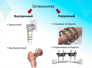 Интрамедуллярный эластичный остеосинтез при диафизарных переломах у детей (часть 2) Интрамедуллярный эластичный остеосинтез при диафизарных переломах у детей (часть 2)