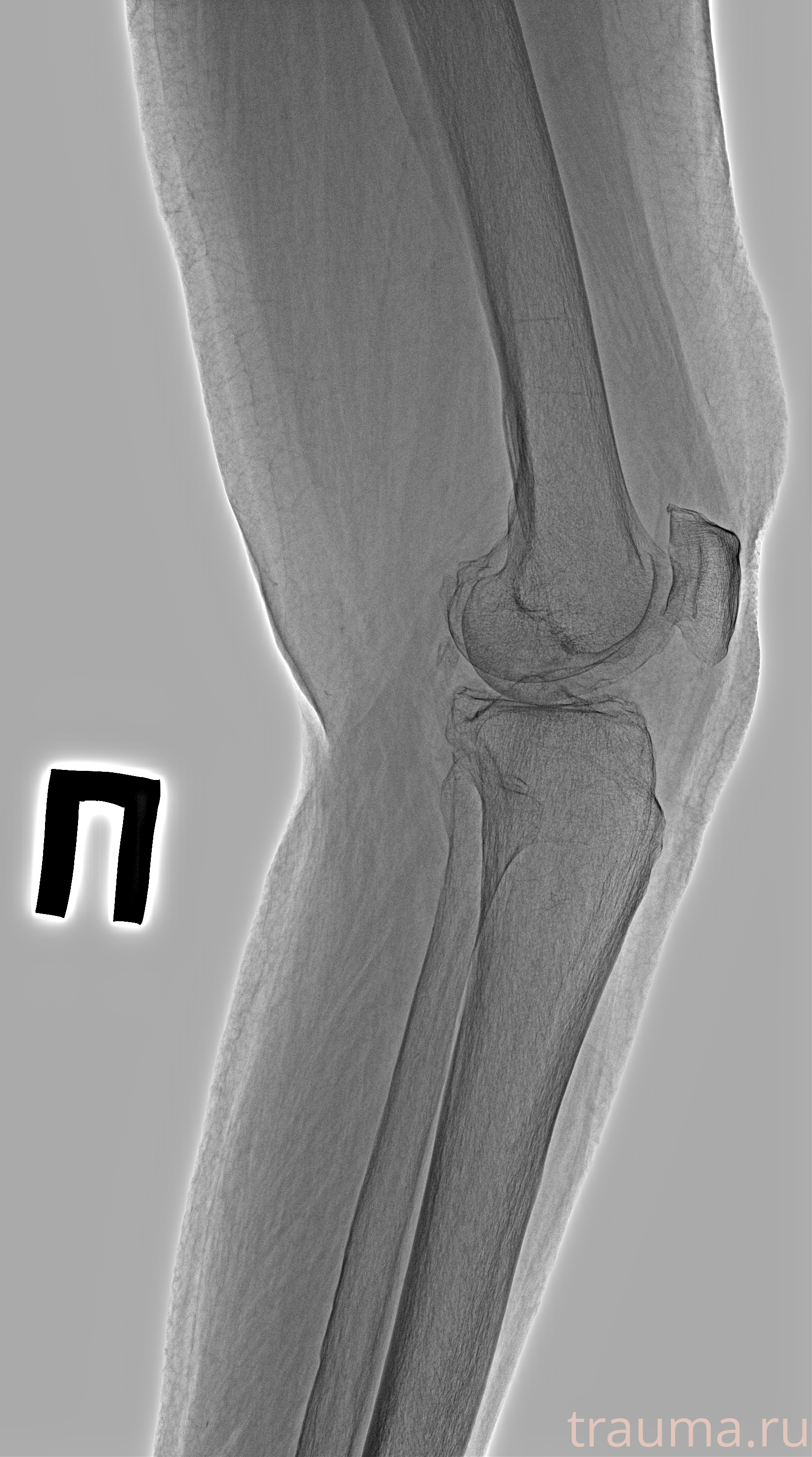 Рентген на дому: по вашему адресу приезжает врач-рентгенолог, травматолог-ортопед с мобильным рентгеновским аппаратом, проводит диагностику травмы или заболевания, делает необходимые рентгенограммы, дает рекомендации по дальнейшему лечению. Получить качественные снимки в домашних условиях возможно благодаря уникальной методике, разработанной МосРентген Центром для института  Склифосовского