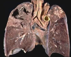 Хирургическое лечение легочного туберкулёза