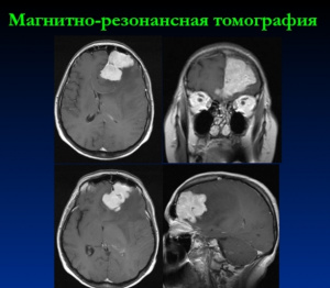Возможности магнитно-резонансной томографии в визуализации черепных нервов Возможности магнитно-резонансной томографии в визуализации черепных нервов