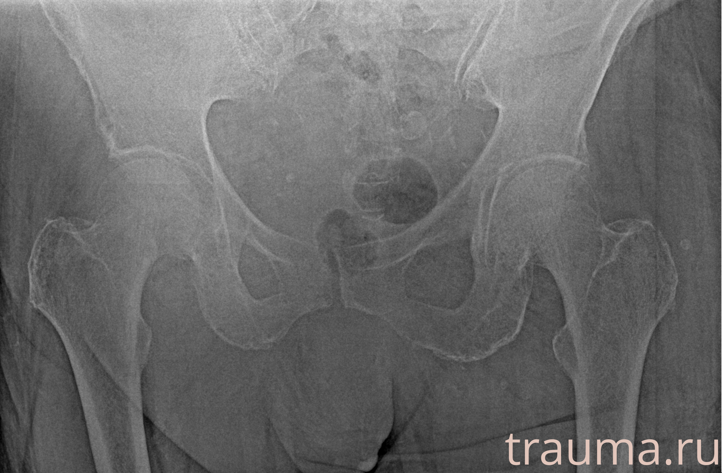 Рентген на дому: по вашему адресу приезжает врач-рентгенолог, травматолог-ортопед с мобильным рентгеновским аппаратом, проводит диагностику травмы или заболевания, делает необходимые рентгенограммы, дает рекомендации по дальнейшему лечению. Получить качественные снимки в домашних условиях возможно благодаря уникальной методике, разработанной МосРентген Центром для института  Склифосовского