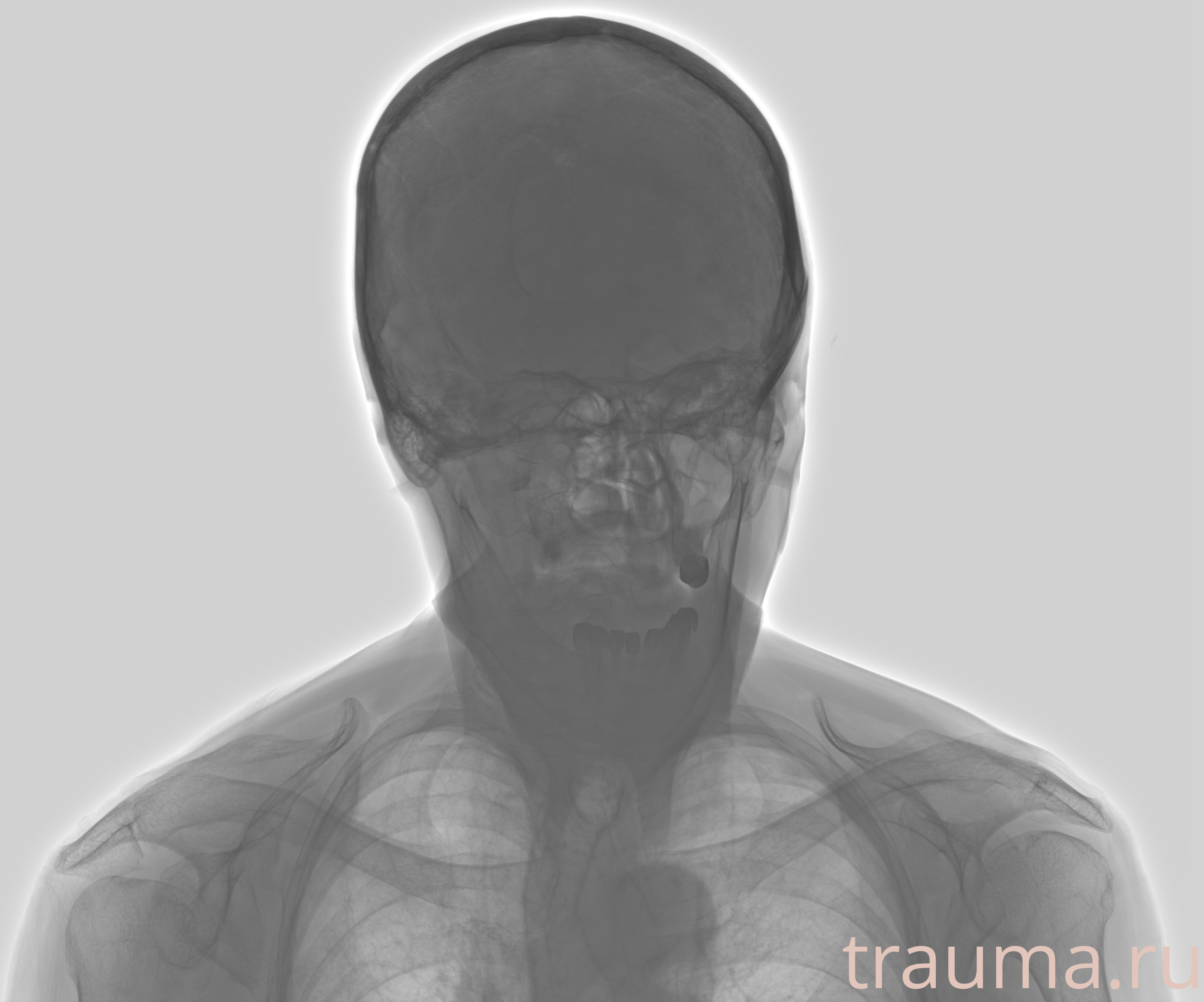 Рентген на дому: по вашему адресу приезжает врач-рентгенолог, травматолог-ортопед с мобильным рентгеновским аппаратом, проводит диагностику травмы или заболевания, делает необходимые рентгенограммы, дает рекомендации по дальнейшему лечению. Получить качественные снимки в домашних условиях возможно благодаря уникальной методике, разработанной МосРентген Центром для института  Склифосовского