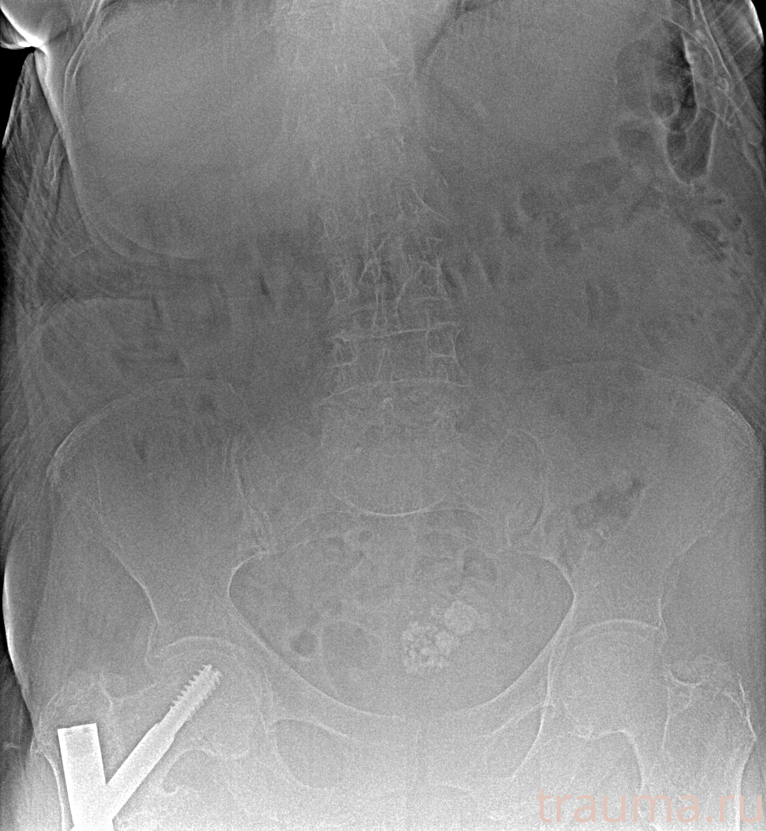 Рентген на дому: по вашему адресу приезжает врач-рентгенолог, травматолог-ортопед с мобильным рентгеновским аппаратом, проводит диагностику травмы или заболевания, делает необходимые рентгенограммы, дает рекомендации по дальнейшему лечению. Получить качественные снимки в домашних условиях возможно благодаря уникальной методике, разработанной МосРентген Центром для института  Склифосовского