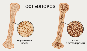 Место ризедроната в лечении  постменопаузального  остеопароза
