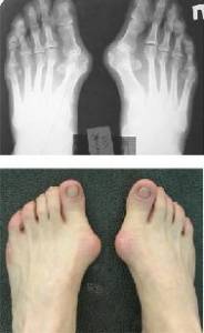 Накостный остеосинтез при лечении hallux valgus Накостный остеосинтез при лечении hallux valgus