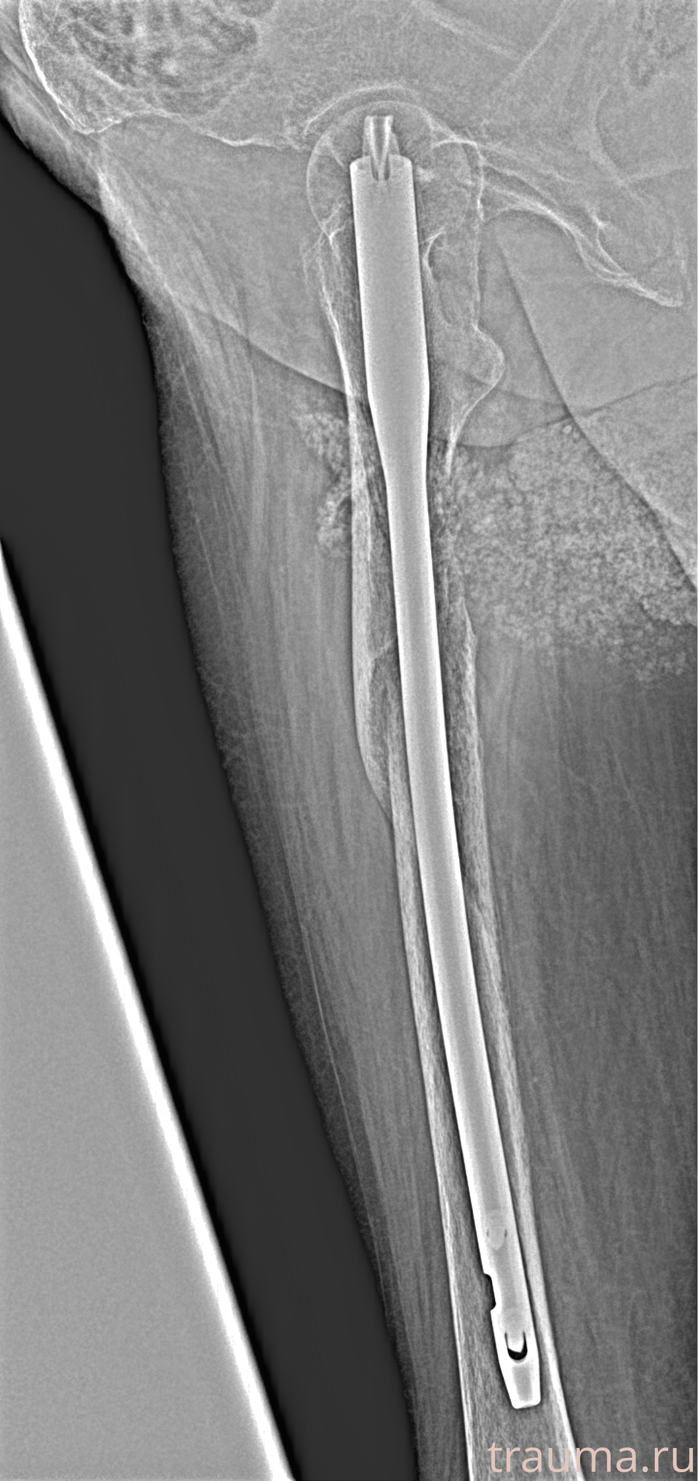 Рентген на дому: по вашему адресу приезжает врач-рентгенолог, травматолог-ортопед с мобильным рентгеновским аппаратом, проводит диагностику травмы или заболевания, делает необходимые рентгенограммы, дает рекомендации по дальнейшему лечению. Получить качественные снимки в домашних условиях возможно благодаря уникальной методике, разработанной МосРентген Центром для института  Склифосовского