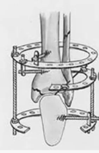 Опыт минимальноинвазивного накостного остеосинтеза переломов дистального отдела костей голени
