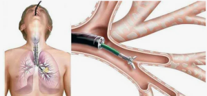 Возможности бронхоальвеолярного лаважа в диагностике прогрессирующего легочного фиброза
