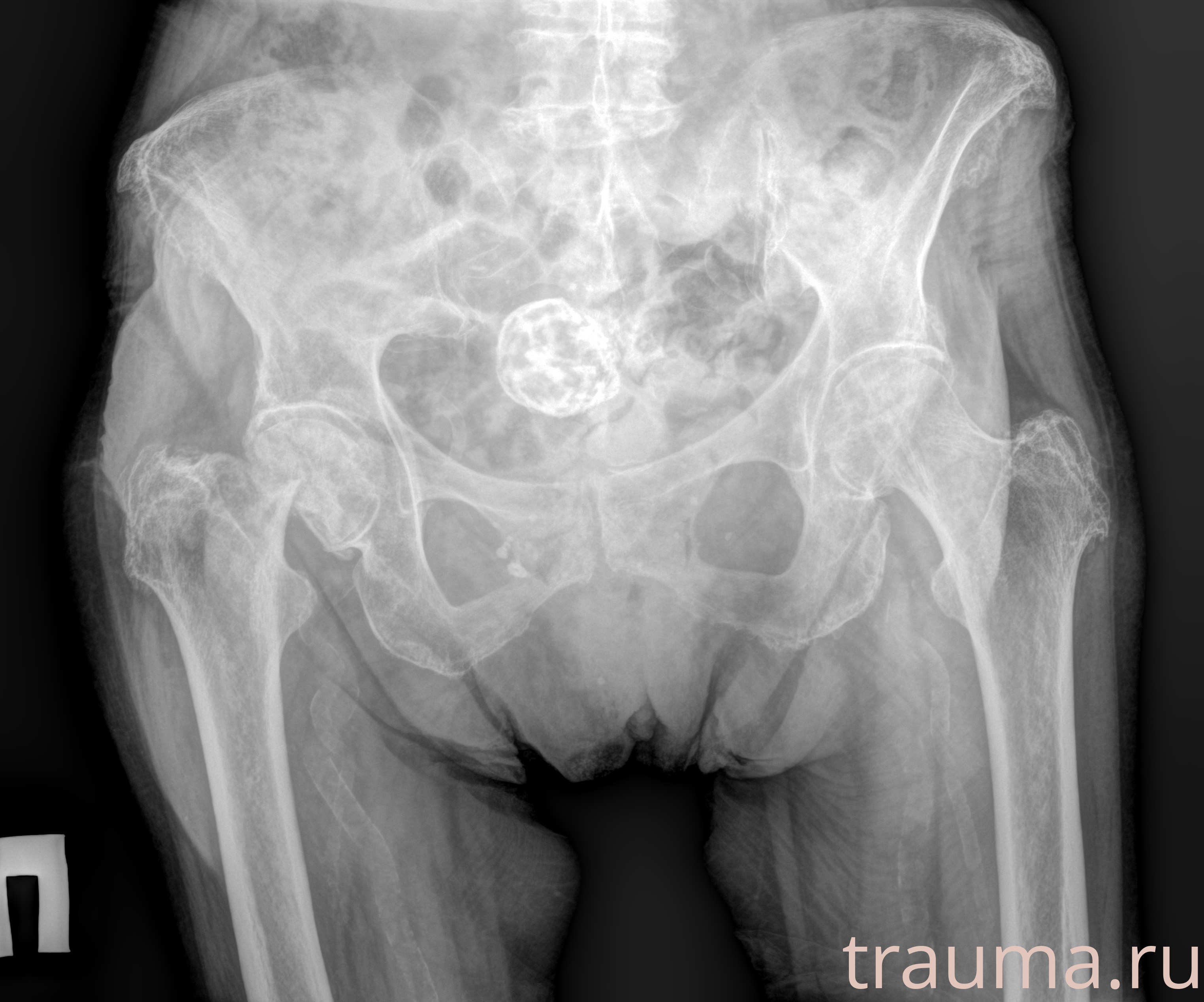 Рентген на дому: по вашему адресу приезжает врач-рентгенолог, травматолог-ортопед с мобильным рентгеновским аппаратом, проводит диагностику травмы или заболевания, делает необходимые рентгенограммы, дает рекомендации по дальнейшему лечению. Получить качественные снимки в домашних условиях возможно благодаря уникальной методике, разработанной МосРентген Центром для института  Склифосовского