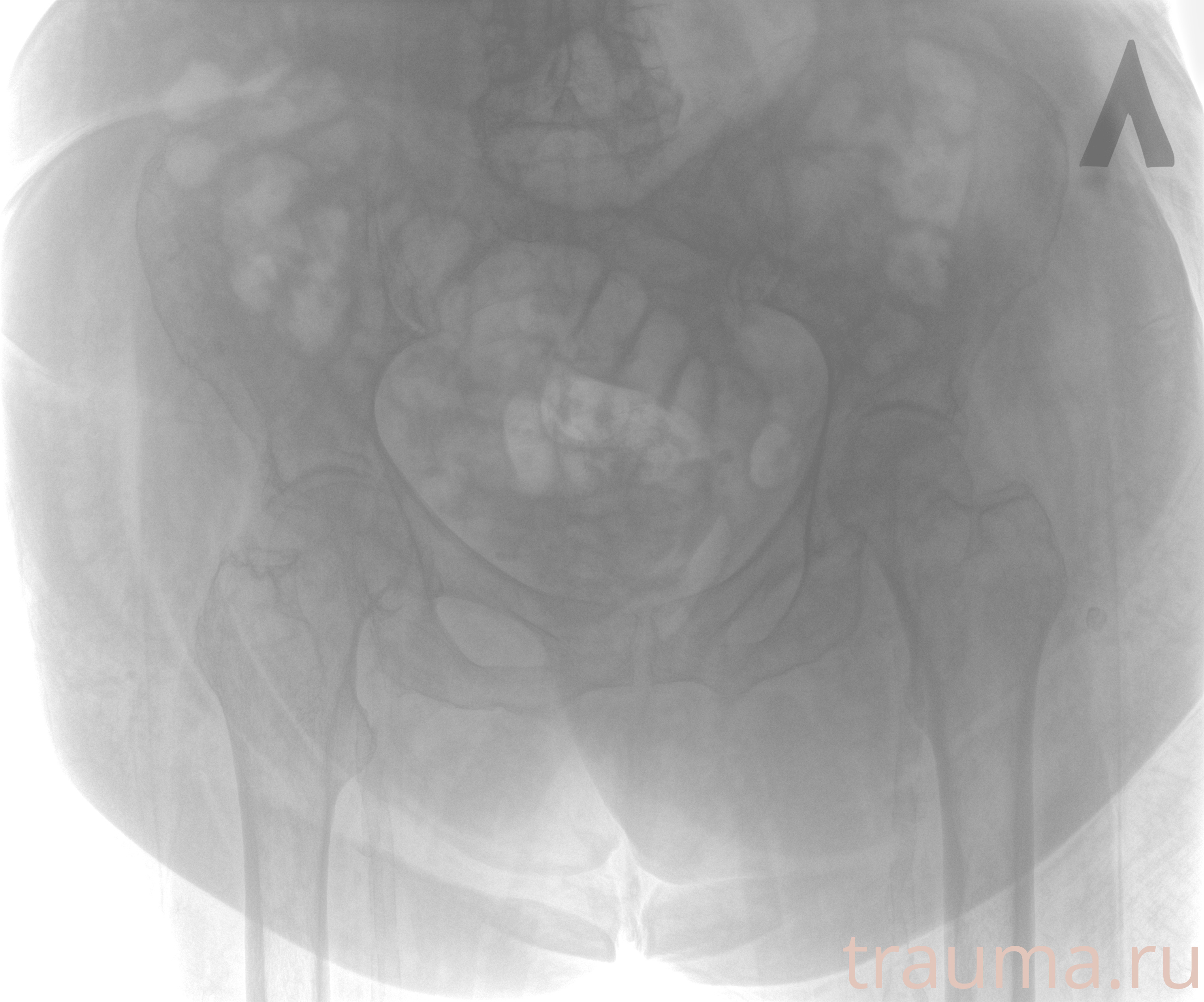 Рентген на дому: по вашему адресу приезжает врач-рентгенолог, травматолог-ортопед с мобильным рентгеновским аппаратом, проводит диагностику травмы или заболевания, делает необходимые рентгенограммы, дает рекомендации по дальнейшему лечению. Получить качественные снимки в домашних условиях возможно благодаря уникальной методике, разработанной МосРентген Центром для института  Склифосовского
