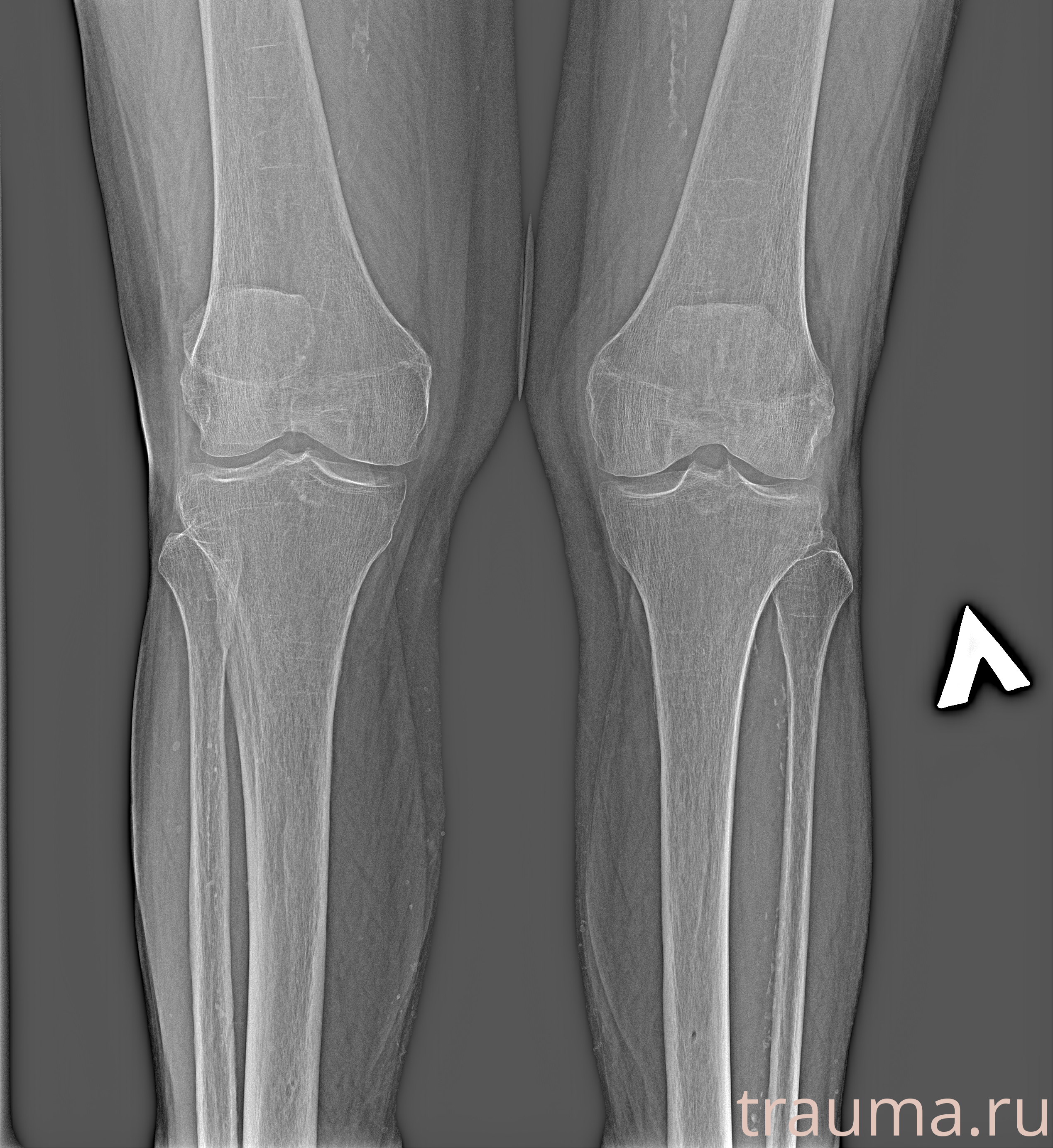Рентген на дому: по вашему адресу приезжает врач-рентгенолог, травматолог-ортопед с мобильным рентгеновским аппаратом, проводит диагностику травмы или заболевания, делает необходимые рентгенограммы, дает рекомендации по дальнейшему лечению. Получить качественные снимки в домашних условиях возможно благодаря уникальной методике, разработанной МосРентген Центром для института  Склифосовского