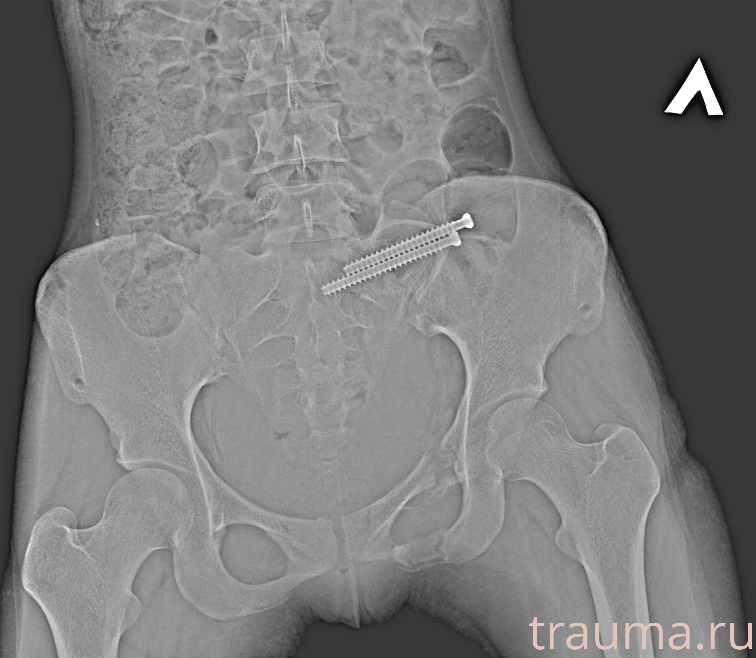 Рентген на дому: по вашему адресу приезжает врач-рентгенолог, травматолог-ортопед с мобильным рентгеновским аппаратом, проводит диагностику травмы или заболевания, делает необходимые рентгенограммы, дает рекомендации по дальнейшему лечению. Получить качественные снимки в домашних условиях возможно благодаря уникальной методике, разработанной МосРентген Центром для института  Склифосовского
