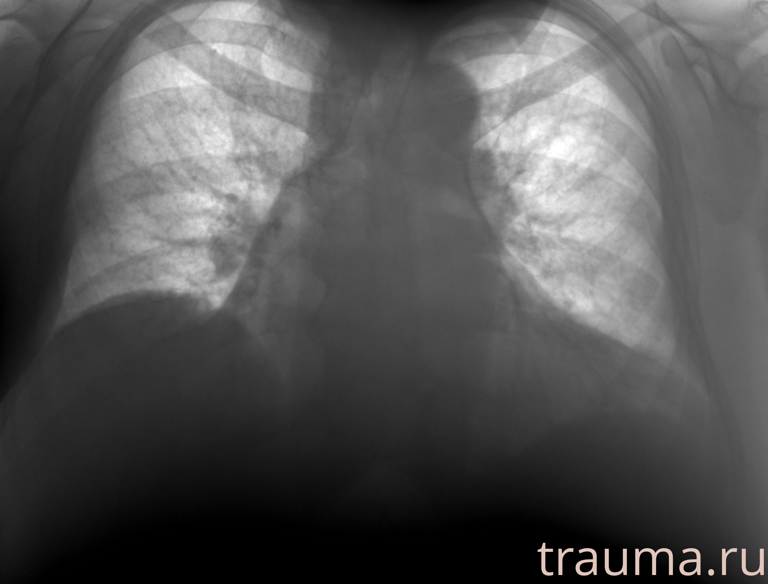 Рентген на дому: по вашему адресу приезжает врач-рентгенолог, травматолог-ортопед с мобильным рентгеновским аппаратом, проводит диагностику травмы или заболевания, делает необходимые рентгенограммы, дает рекомендации по дальнейшему лечению. Получить качественные снимки в домашних условиях возможно благодаря уникальной методике, разработанной МосРентген Центром для института  Склифосовского