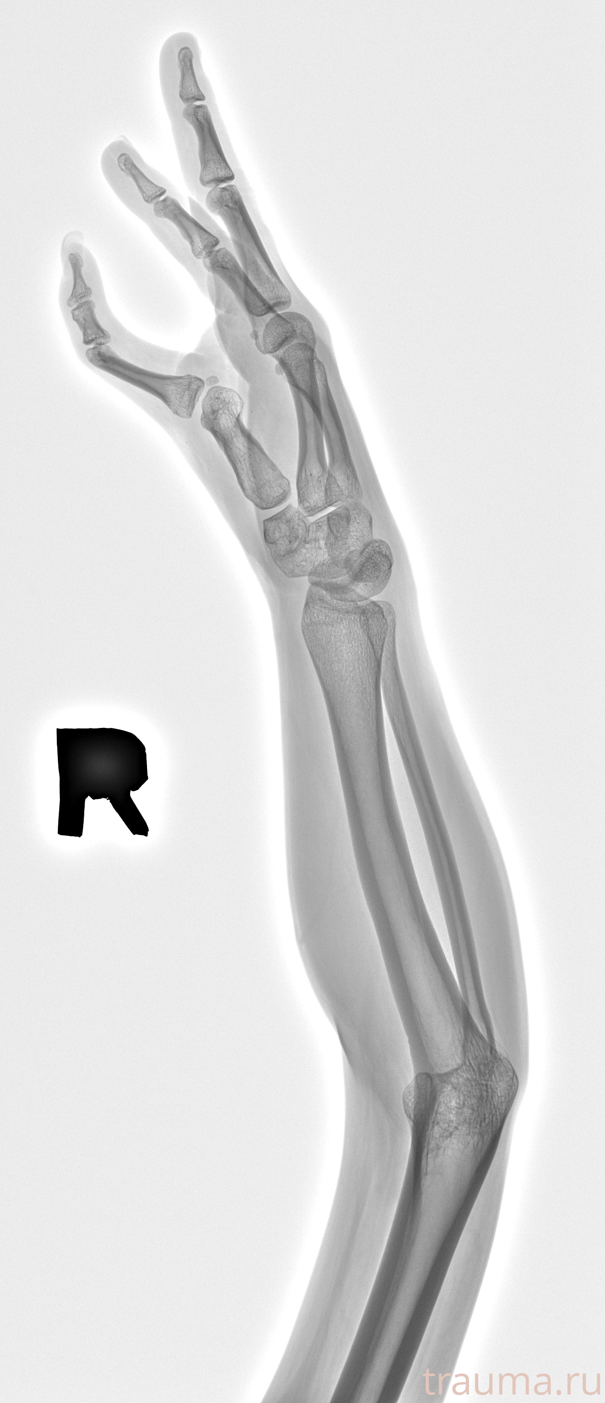 Рентген на дому: по вашему адресу приезжает врач-рентгенолог, травматолог-ортопед с мобильным рентгеновским аппаратом, проводит диагностику травмы или заболевания, делает необходимые рентгенограммы, дает рекомендации по дальнейшему лечению. Получить качественные снимки в домашних условиях возможно благодаря уникальной методике, разработанной МосРентген Центром для института  Склифосовского