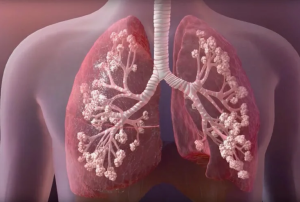 Редкое диффузное кистозное заболевание легких