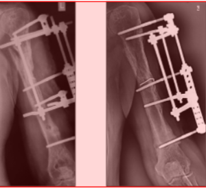 Чрескостный остеосинтез диафизарных переломов костей предплечья