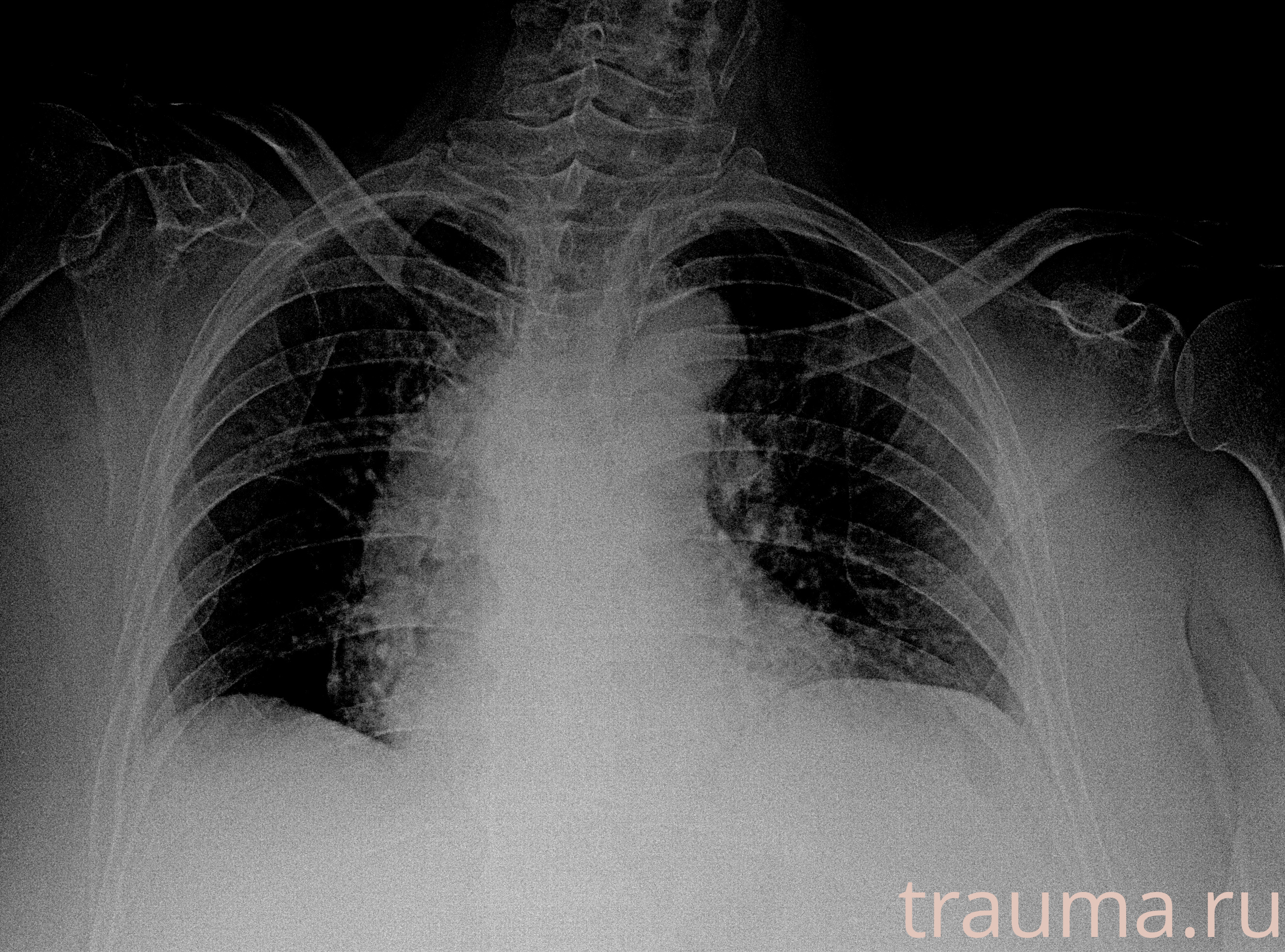 Рентген на дому: по вашему адресу приезжает врач-рентгенолог, травматолог-ортопед с мобильным рентгеновским аппаратом, проводит диагностику травмы или заболевания, делает необходимые рентгенограммы, дает рекомендации по дальнейшему лечению. Получить качественные снимки в домашних условиях возможно благодаря уникальной методике, разработанной МосРентген Центром для института  Склифосовского
