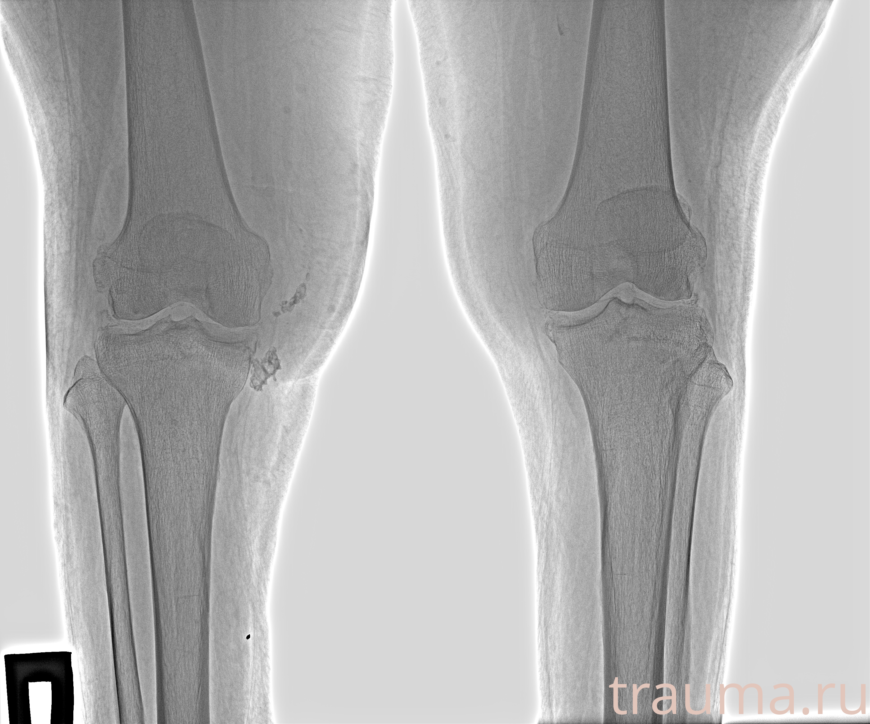 Рентген на дому: по вашему адресу приезжает врач-рентгенолог, травматолог-ортопед с мобильным рентгеновским аппаратом, проводит диагностику травмы или заболевания, делает необходимые рентгенограммы, дает рекомендации по дальнейшему лечению. Получить качественные снимки в домашних условиях возможно благодаря уникальной методике, разработанной МосРентген Центром для института  Склифосовского