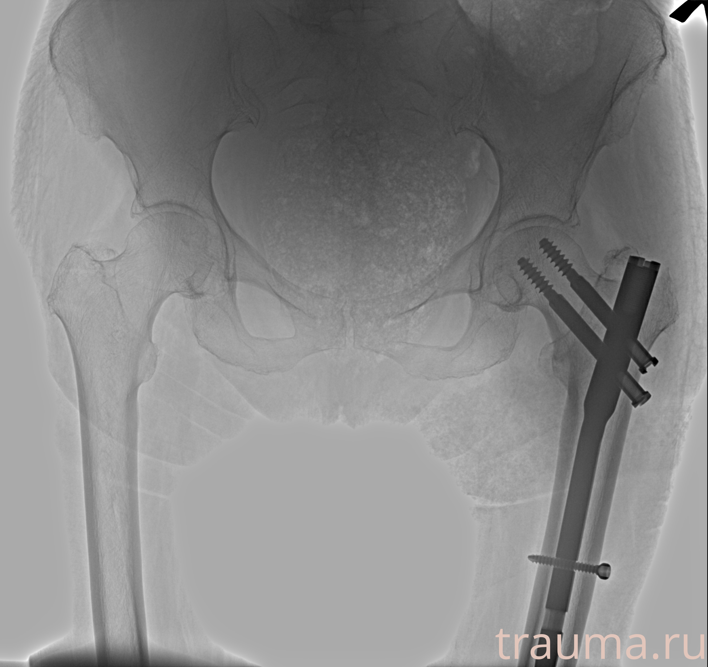 Рентген на дому: по вашему адресу приезжает врач-рентгенолог, травматолог-ортопед с мобильным рентгеновским аппаратом, проводит диагностику травмы или заболевания, делает необходимые рентгенограммы, дает рекомендации по дальнейшему лечению. Получить качественные снимки в домашних условиях возможно благодаря уникальной методике, разработанной МосРентген Центром для института  Склифосовского