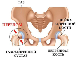 Анализ экономической и клинической эффективности одно- и двухэтапных ревизий при лечении перипротезной инфекции тазобедренного сустава (обзор литературы) Анализ экономической и клинической эффективности одно- и двухэтапных ревизий при лечении перипротезной инфекции тазобедренного сустава (обзор литературы)
