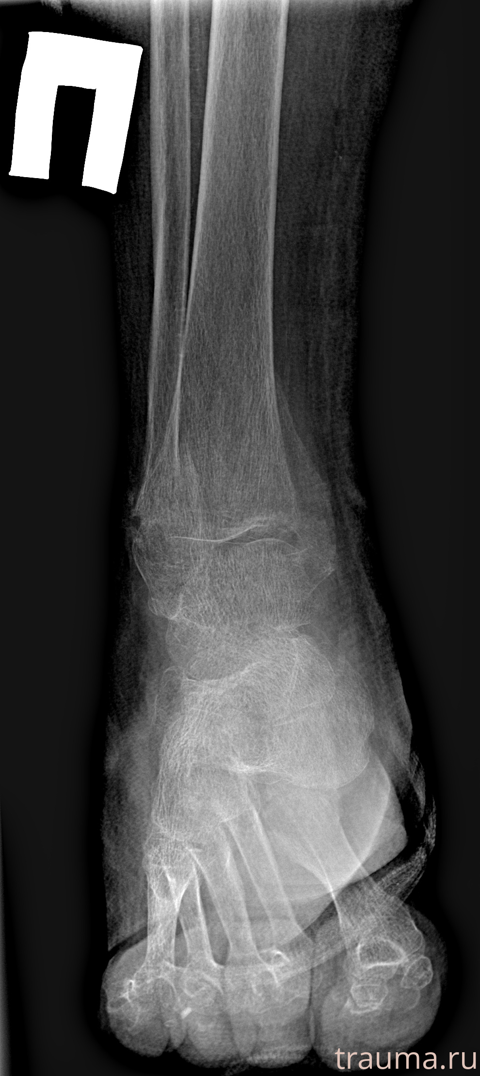 Рентген на дому: по вашему адресу приезжает врач-рентгенолог, травматолог-ортопед с мобильным рентгеновским аппаратом, проводит диагностику травмы или заболевания, делает необходимые рентгенограммы, дает рекомендации по дальнейшему лечению. Получить качественные снимки в домашних условиях возможно благодаря уникальной методике, разработанной МосРентген Центром для института  Склифосовского