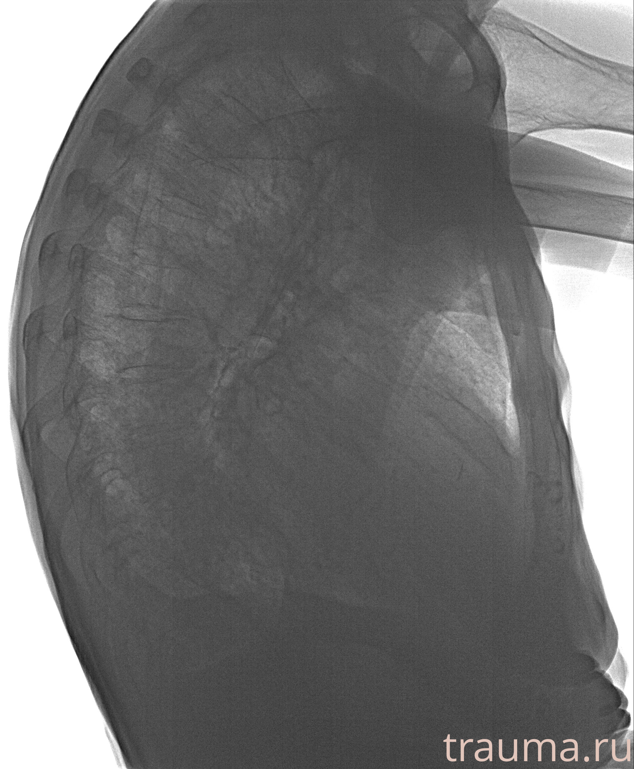 Рентген на дому: по вашему адресу приезжает врач-рентгенолог, травматолог-ортопед с мобильным рентгеновским аппаратом, проводит диагностику травмы или заболевания, делает необходимые рентгенограммы, дает рекомендации по дальнейшему лечению. Получить качественные снимки в домашних условиях возможно благодаря уникальной методике, разработанной МосРентген Центром для института  Склифосовского