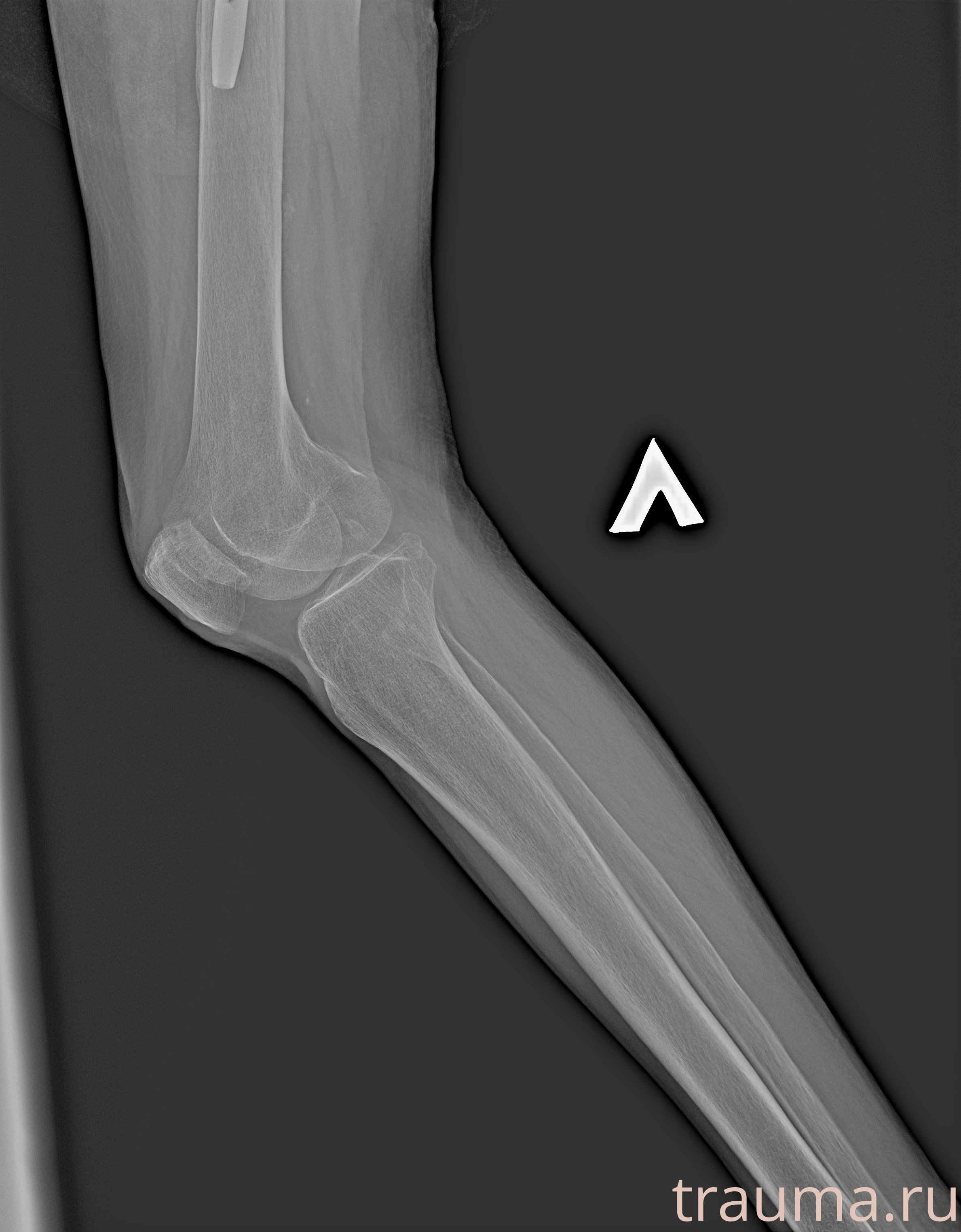 Рентген на дому: по вашему адресу приезжает врач-рентгенолог, травматолог-ортопед с мобильным рентгеновским аппаратом, проводит диагностику травмы или заболевания, делает необходимые рентгенограммы, дает рекомендации по дальнейшему лечению. Получить качественные снимки в домашних условиях возможно благодаря уникальной методике, разработанной МосРентген Центром для института  Склифосовского