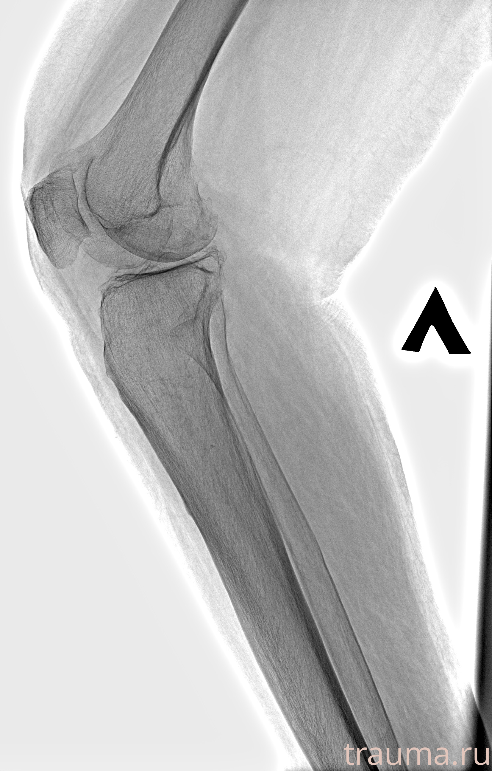 Рентген на дому: по вашему адресу приезжает врач-рентгенолог, травматолог-ортопед с мобильным рентгеновским аппаратом, проводит диагностику травмы или заболевания, делает необходимые рентгенограммы, дает рекомендации по дальнейшему лечению. Получить качественные снимки в домашних условиях возможно благодаря уникальной методике, разработанной МосРентген Центром для института  Склифосовского