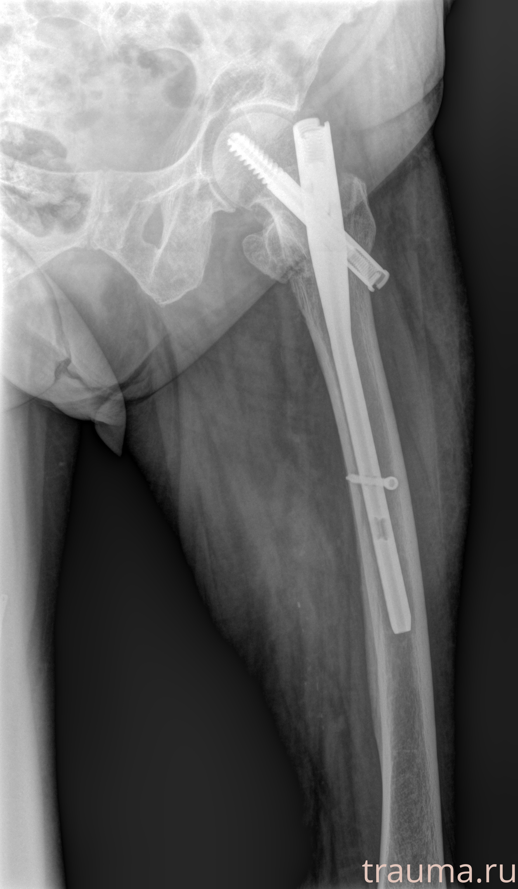 Рентген на дому: по вашему адресу приезжает врач-рентгенолог, травматолог-ортопед с мобильным рентгеновским аппаратом, проводит диагностику травмы или заболевания, делает необходимые рентгенограммы, дает рекомендации по дальнейшему лечению. Получить качественные снимки в домашних условиях возможно благодаря уникальной методике, разработанной МосРентген Центром для института  Склифосовского