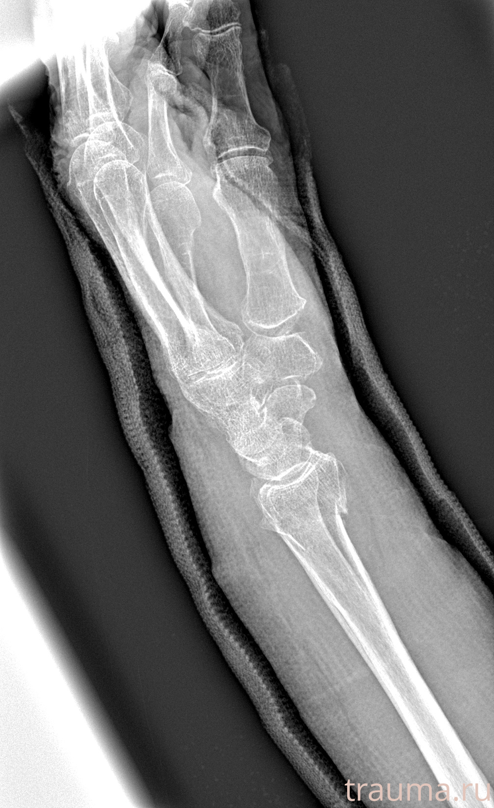 Рентген на дому: по вашему адресу приезжает врач-рентгенолог, травматолог-ортопед с мобильным рентгеновским аппаратом, проводит диагностику травмы или заболевания, делает необходимые рентгенограммы, дает рекомендации по дальнейшему лечению. Получить качественные снимки в домашних условиях возможно благодаря уникальной методике, разработанной МосРентген Центром для института  Склифосовского