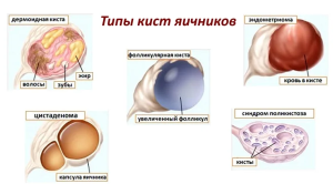 Неэпителиальные опухоли яичников Неэпителиальные опухоли яичников