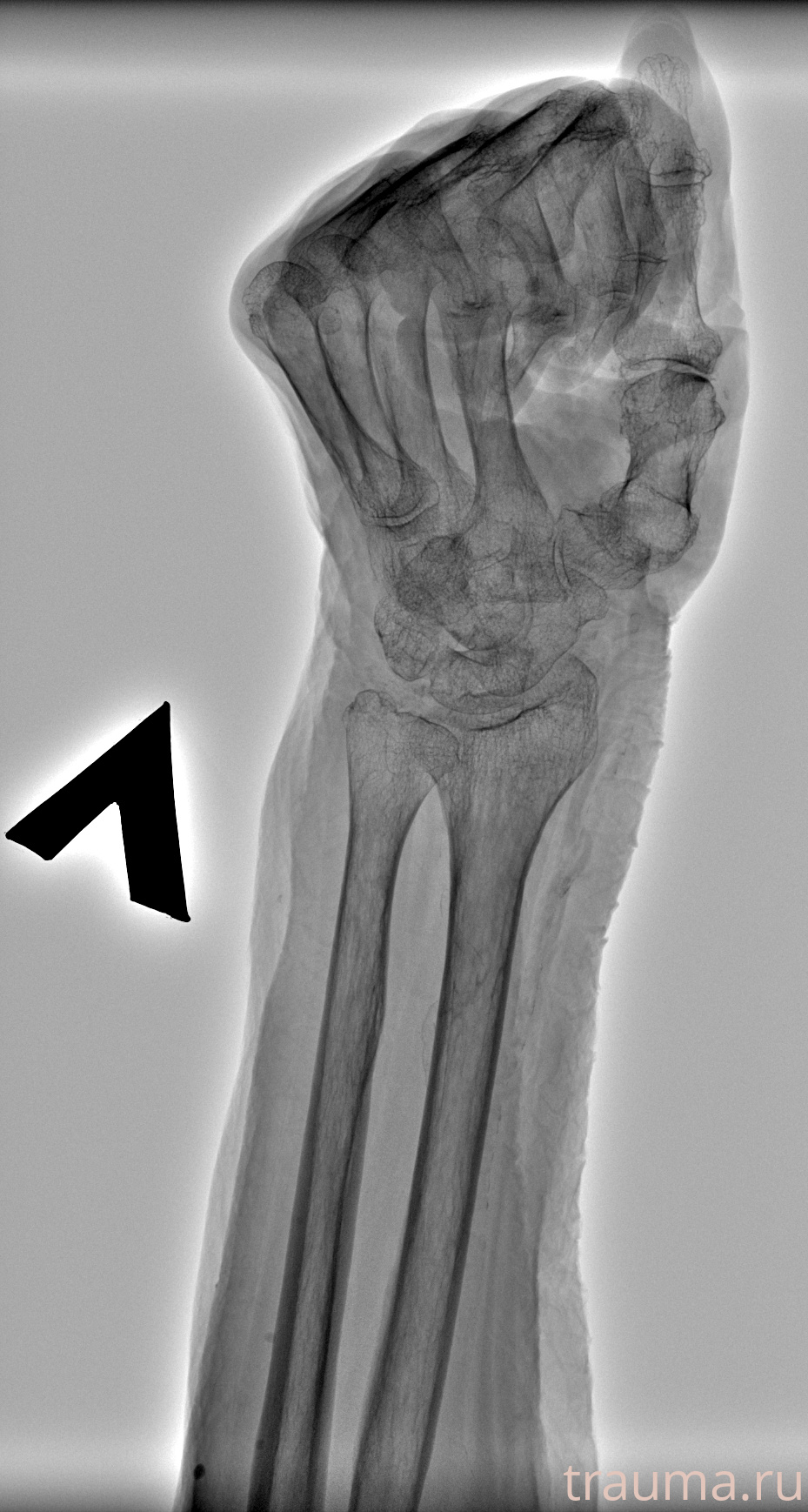 Рентген на дому: по вашему адресу приезжает врач-рентгенолог, травматолог-ортопед с мобильным рентгеновским аппаратом, проводит диагностику травмы или заболевания, делает необходимые рентгенограммы, дает рекомендации по дальнейшему лечению. Получить качественные снимки в домашних условиях возможно благодаря уникальной методике, разработанной МосРентген Центром для института  Склифосовского