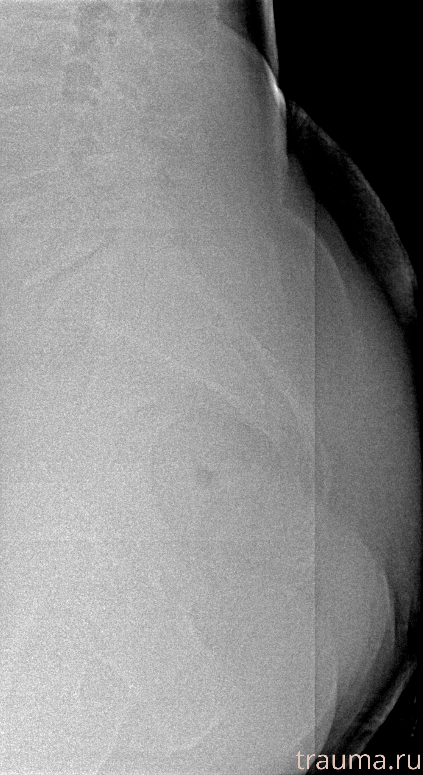 Рентген на дому: по вашему адресу приезжает врач-рентгенолог, травматолог-ортопед с мобильным рентгеновским аппаратом, проводит диагностику травмы или заболевания, делает необходимые рентгенограммы, дает рекомендации по дальнейшему лечению. Получить качественные снимки в домашних условиях возможно благодаря уникальной методике, разработанной МосРентген Центром для института  Склифосовского