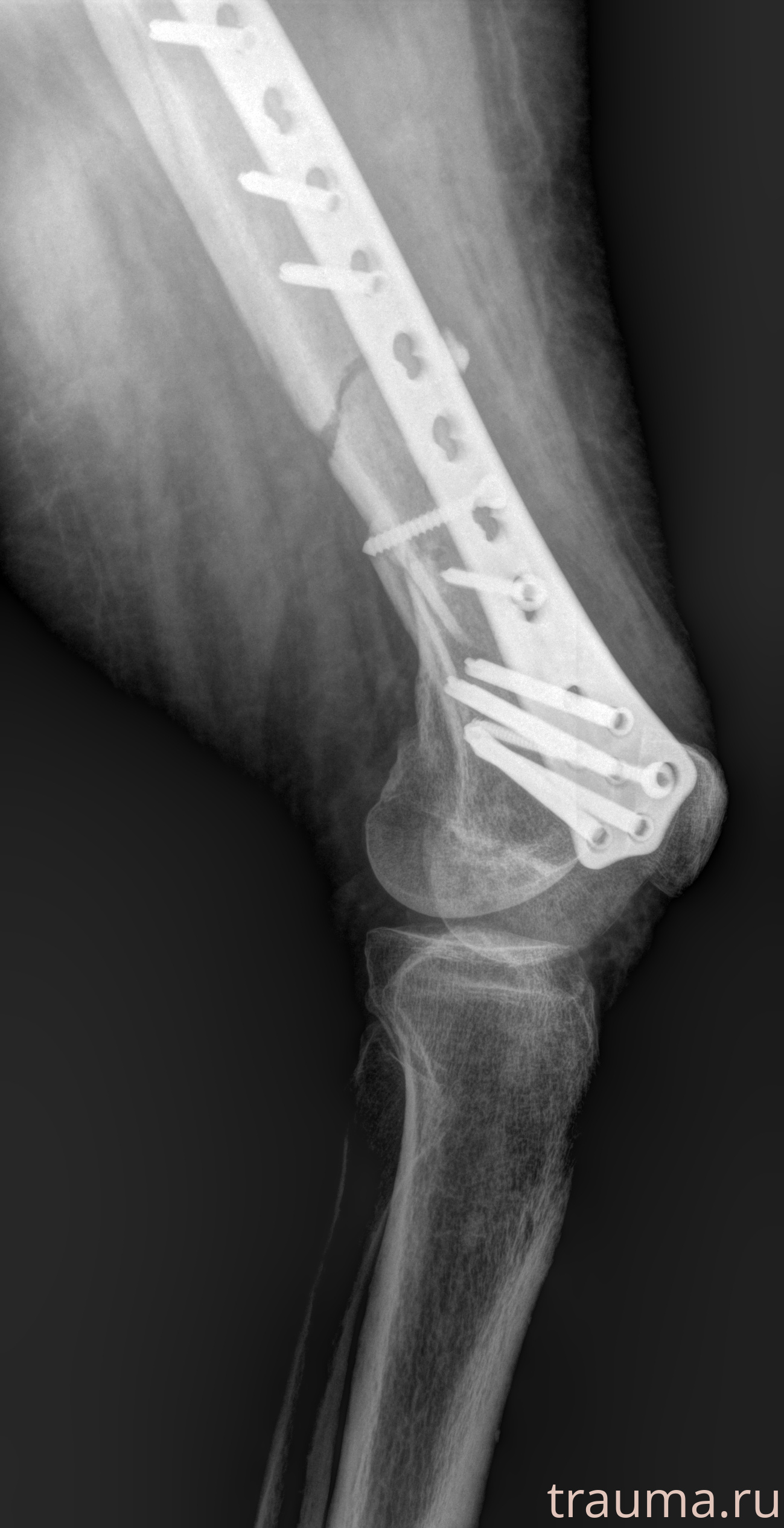 Рентген на дому: по вашему адресу приезжает врач-рентгенолог, травматолог-ортопед с мобильным рентгеновским аппаратом, проводит диагностику травмы или заболевания, делает необходимые рентгенограммы, дает рекомендации по дальнейшему лечению. Получить качественные снимки в домашних условиях возможно благодаря уникальной методике, разработанной МосРентген Центром для института  Склифосовского