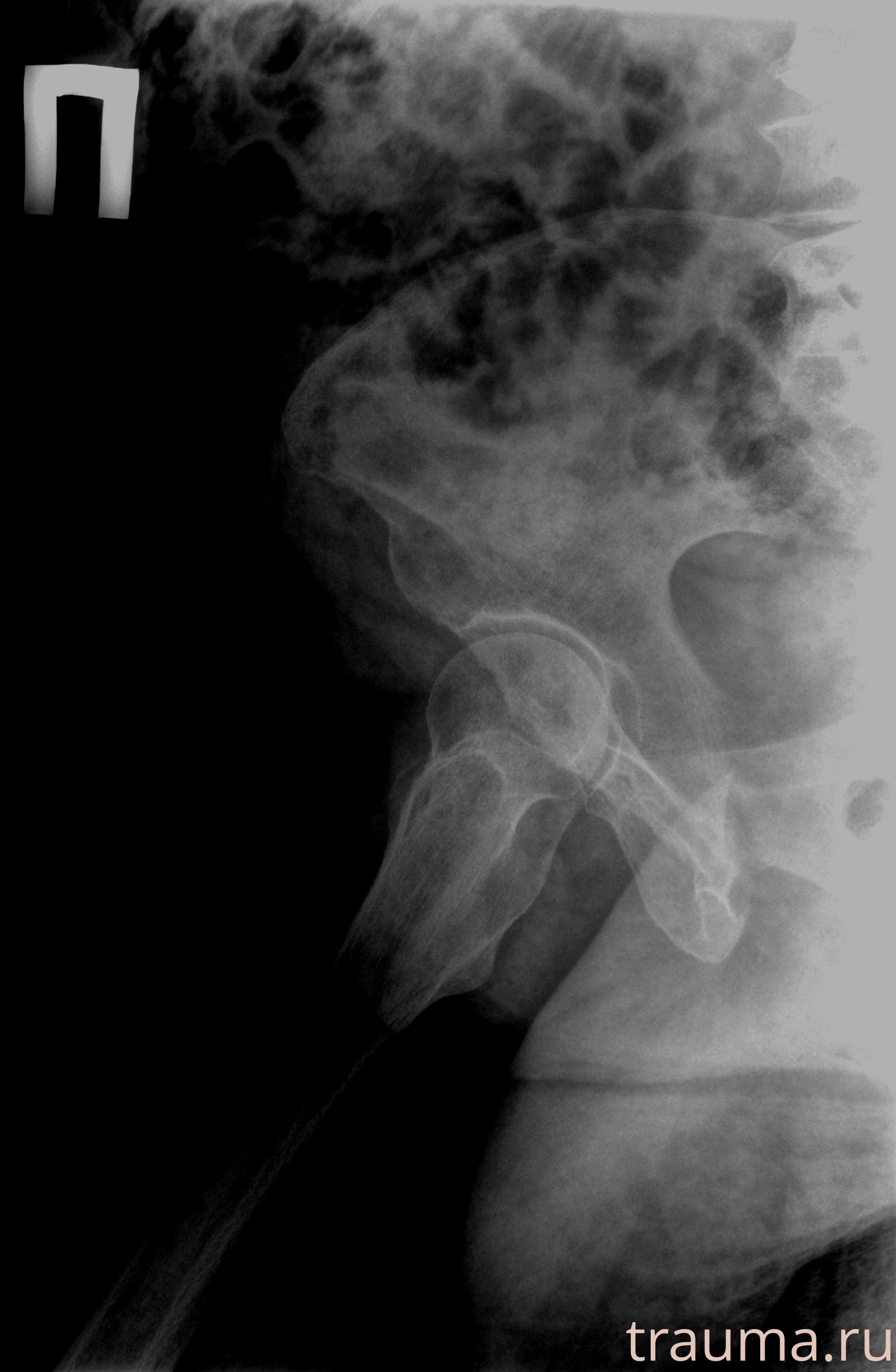 Рентген на дому: по вашему адресу приезжает врач-рентгенолог, травматолог-ортопед с мобильным рентгеновским аппаратом, проводит диагностику травмы или заболевания, делает необходимые рентгенограммы, дает рекомендации по дальнейшему лечению. Получить качественные снимки в домашних условиях возможно благодаря уникальной методике, разработанной МосРентген Центром для института  Склифосовского